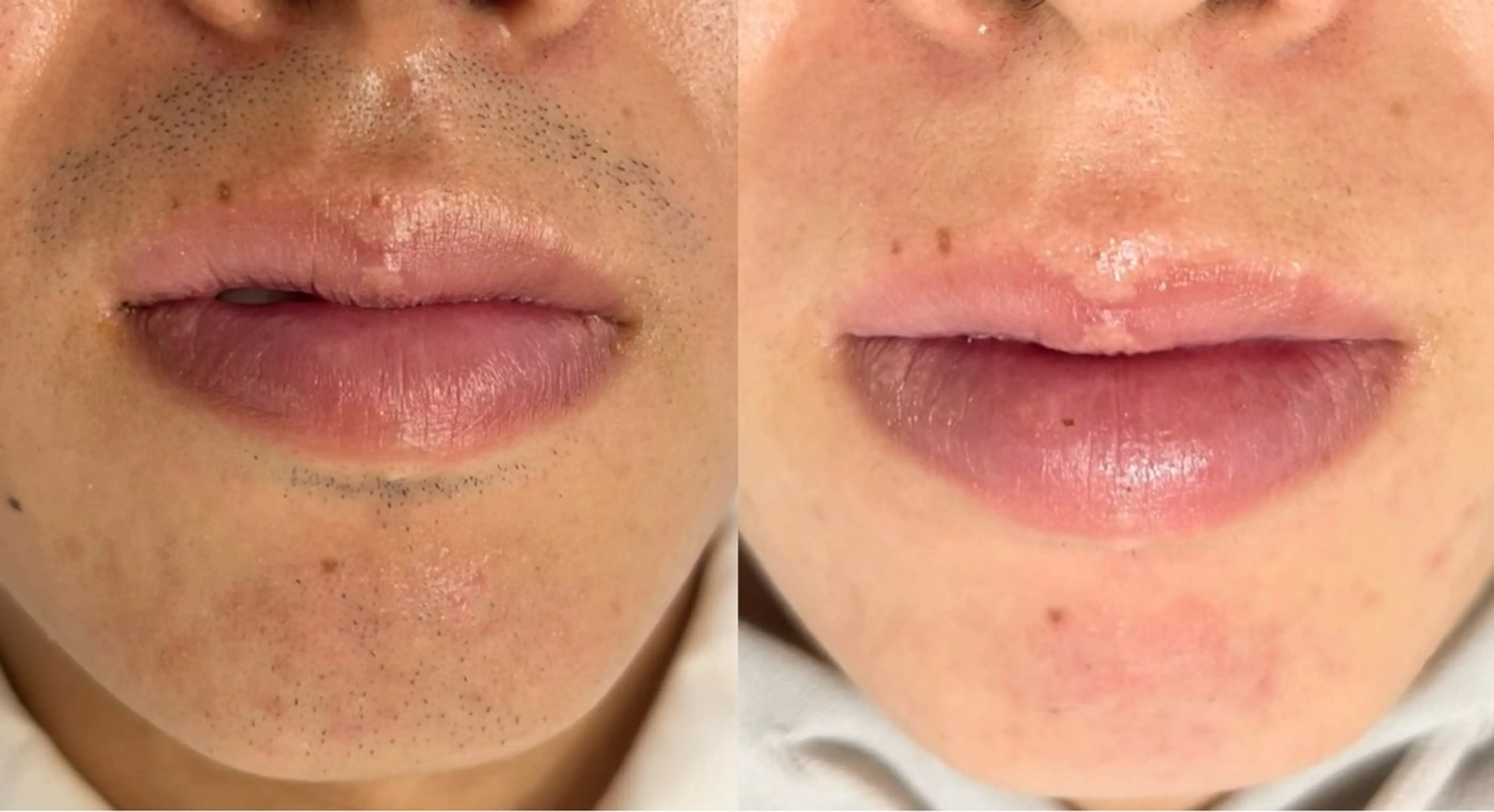 【メンズ♠️】脱毛選べるヒゲor腕orひざ下の写真