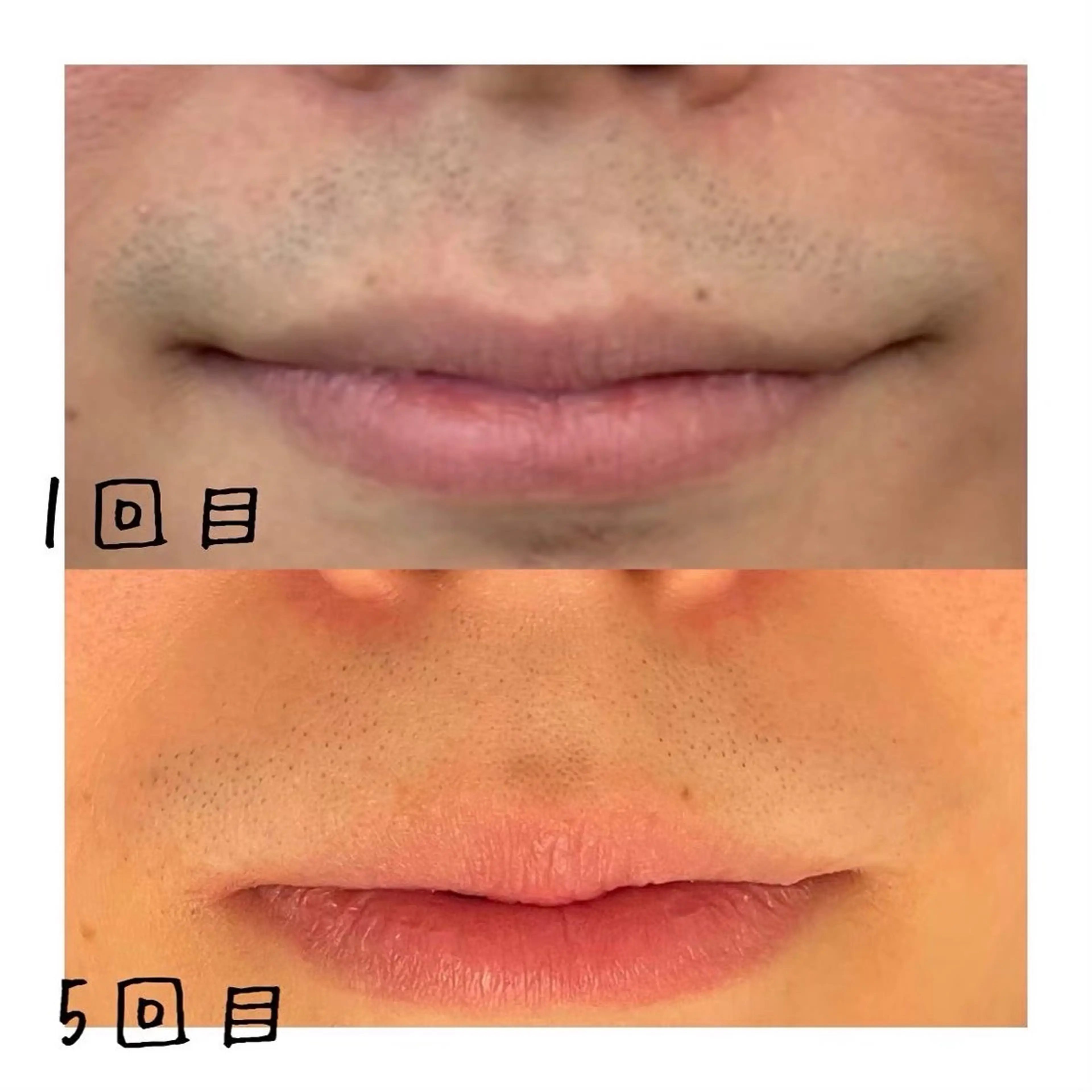 男性ヒゲ脱毛　1パーツ体験付き　【カウンセリング+お試し脱毛】の写真