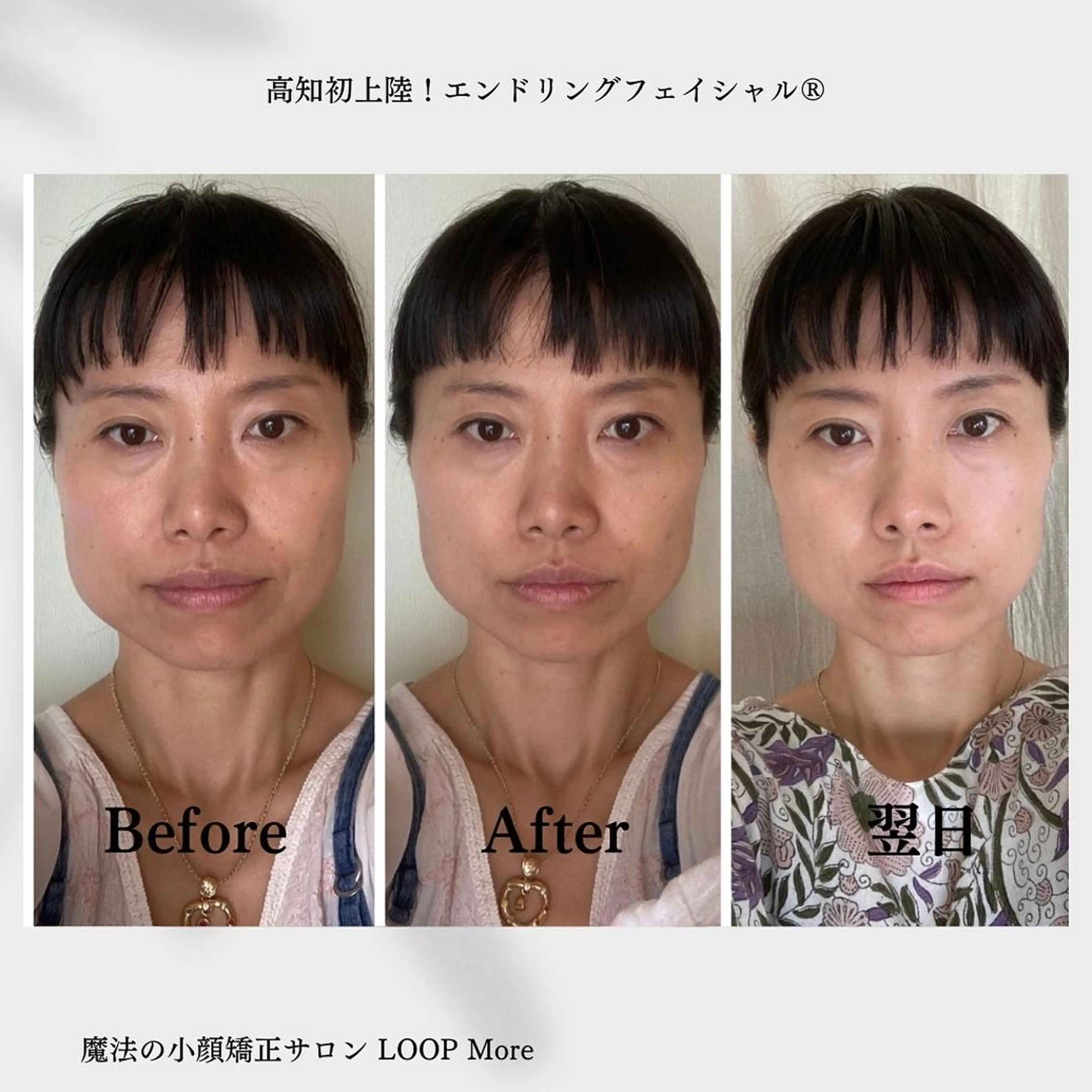 お1人さま1回限り！魔法の小顔矯正【エンドリングフェイシャル】モデルさん募集★ 12000円→3500円の写真