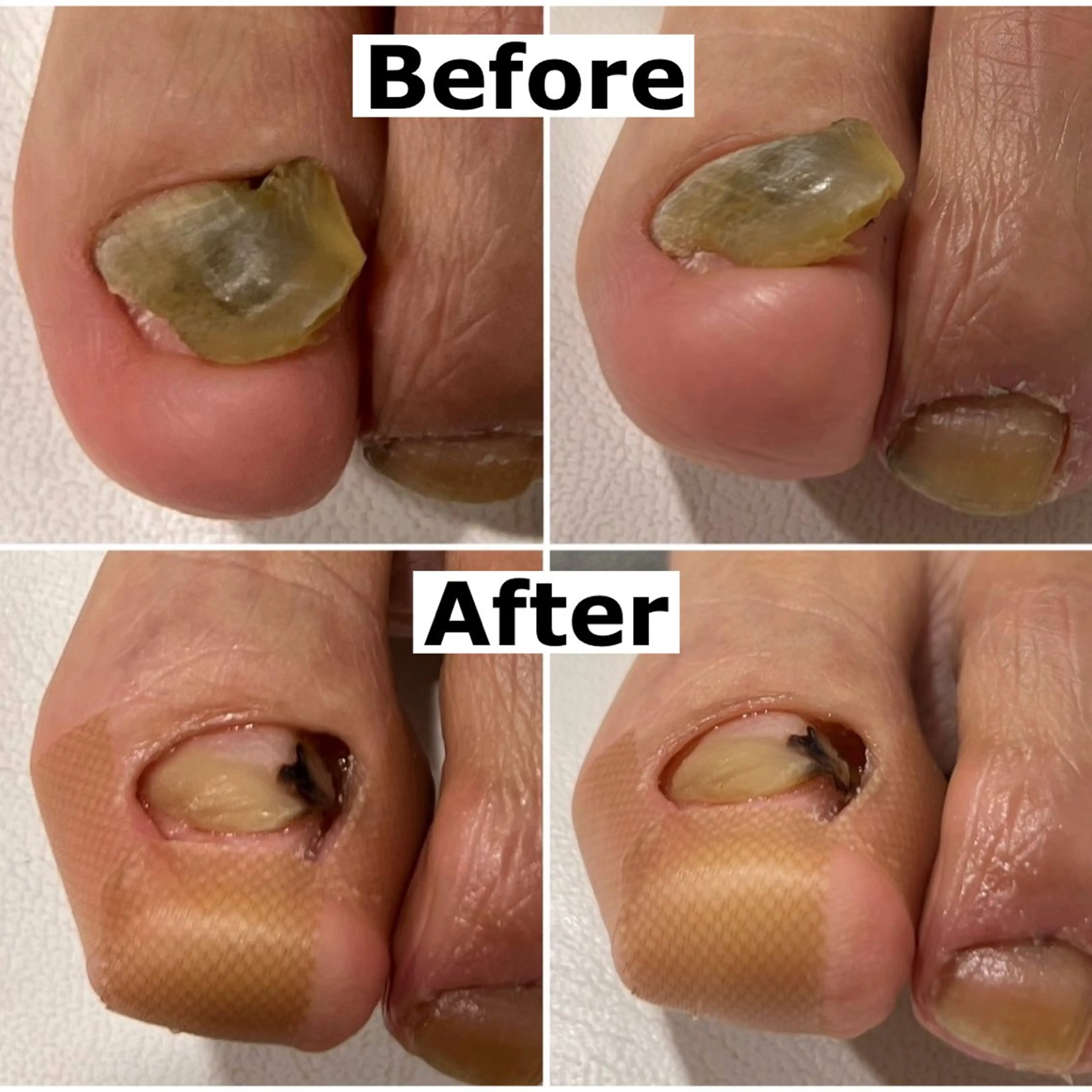 ネイル Mellow nail所属・巻爪無料モデル募集 ✨🦶MEGUMIのネイルデザイン