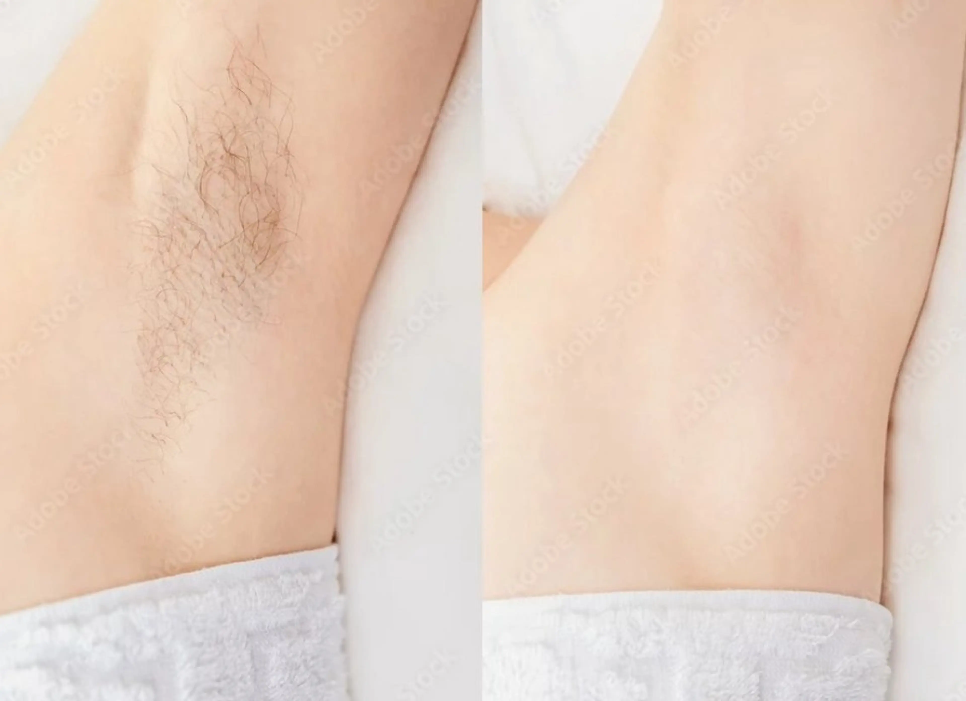 【美肌脱毛】選べるSパーツ/1部位お試し￥2,500→￥980の写真