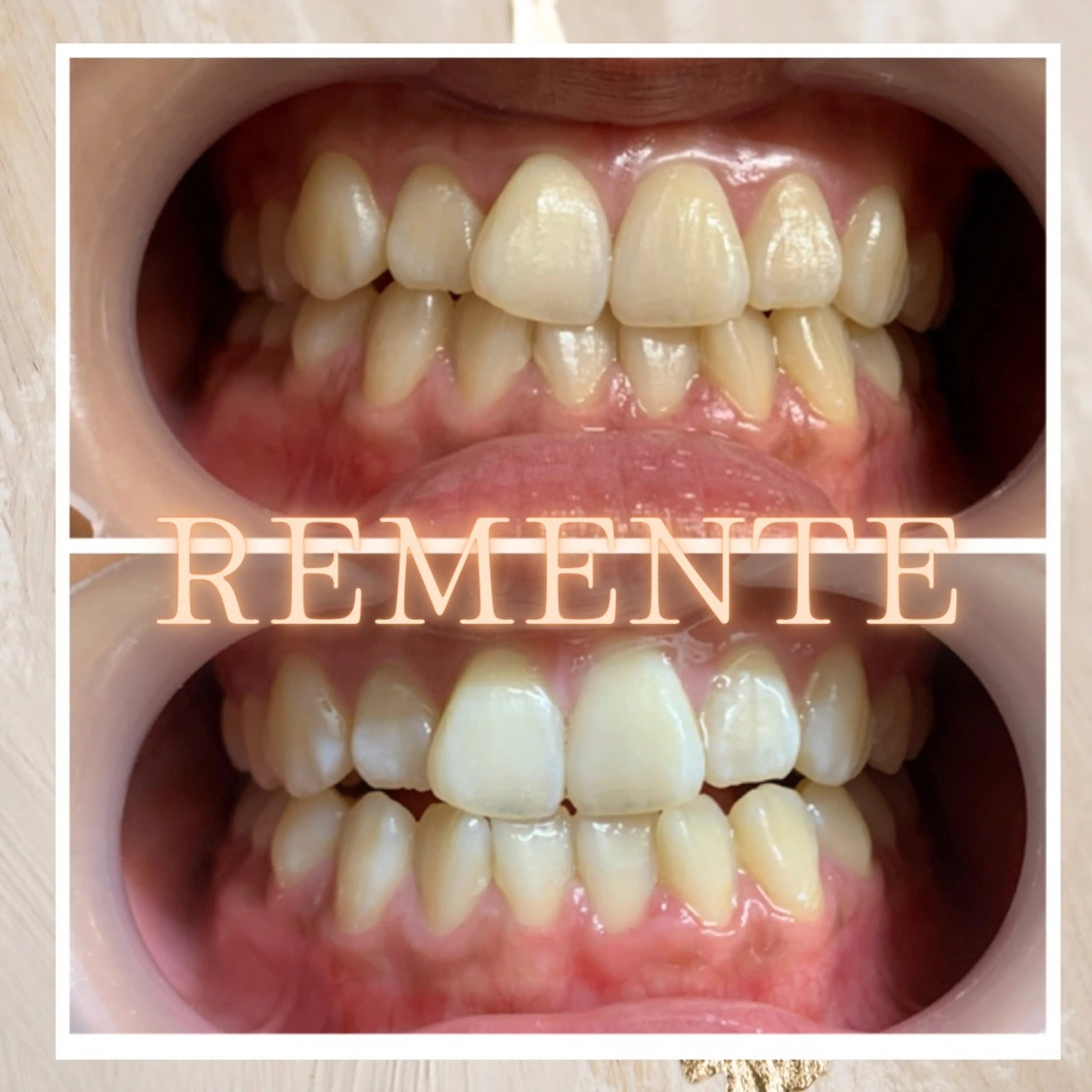 【当日予約限定！】リピート率95%◎魔法のホワイトニング30分◆¥10000→¥2980の写真