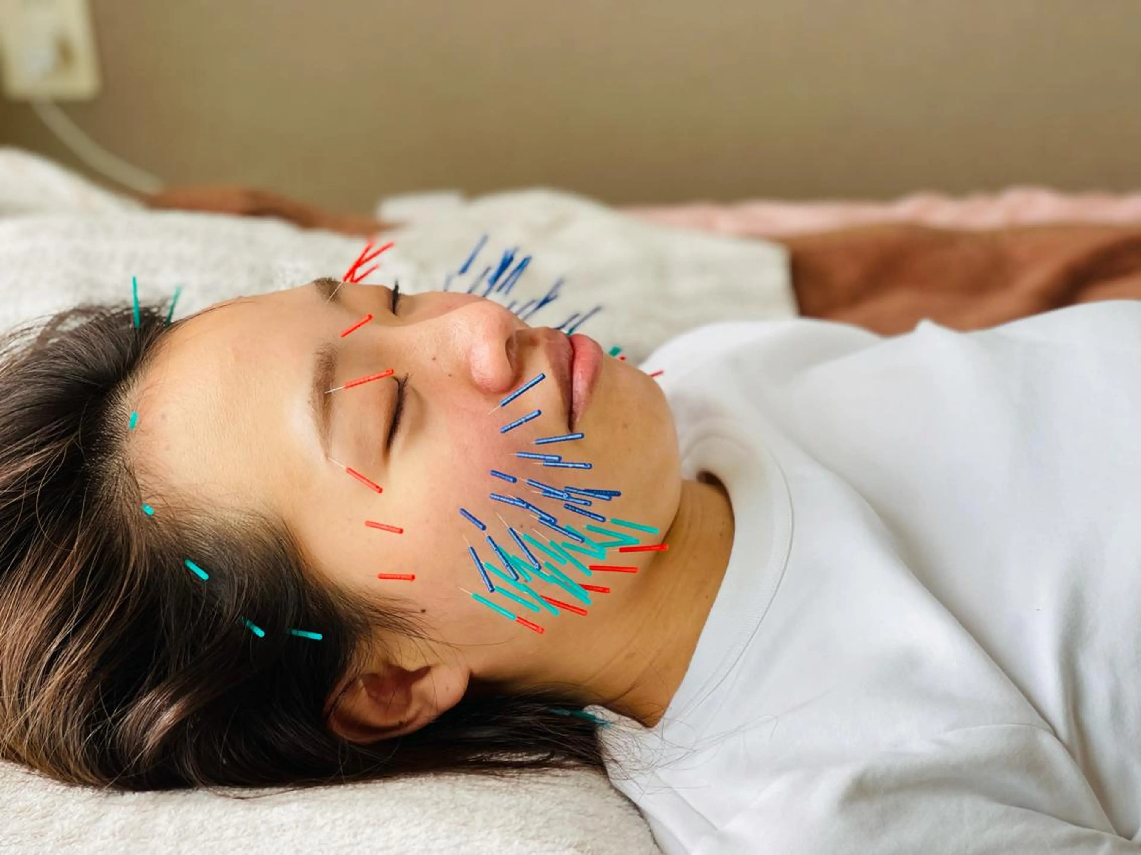 驚異の100本美容鍼(ご新規割引き)🦔の写真