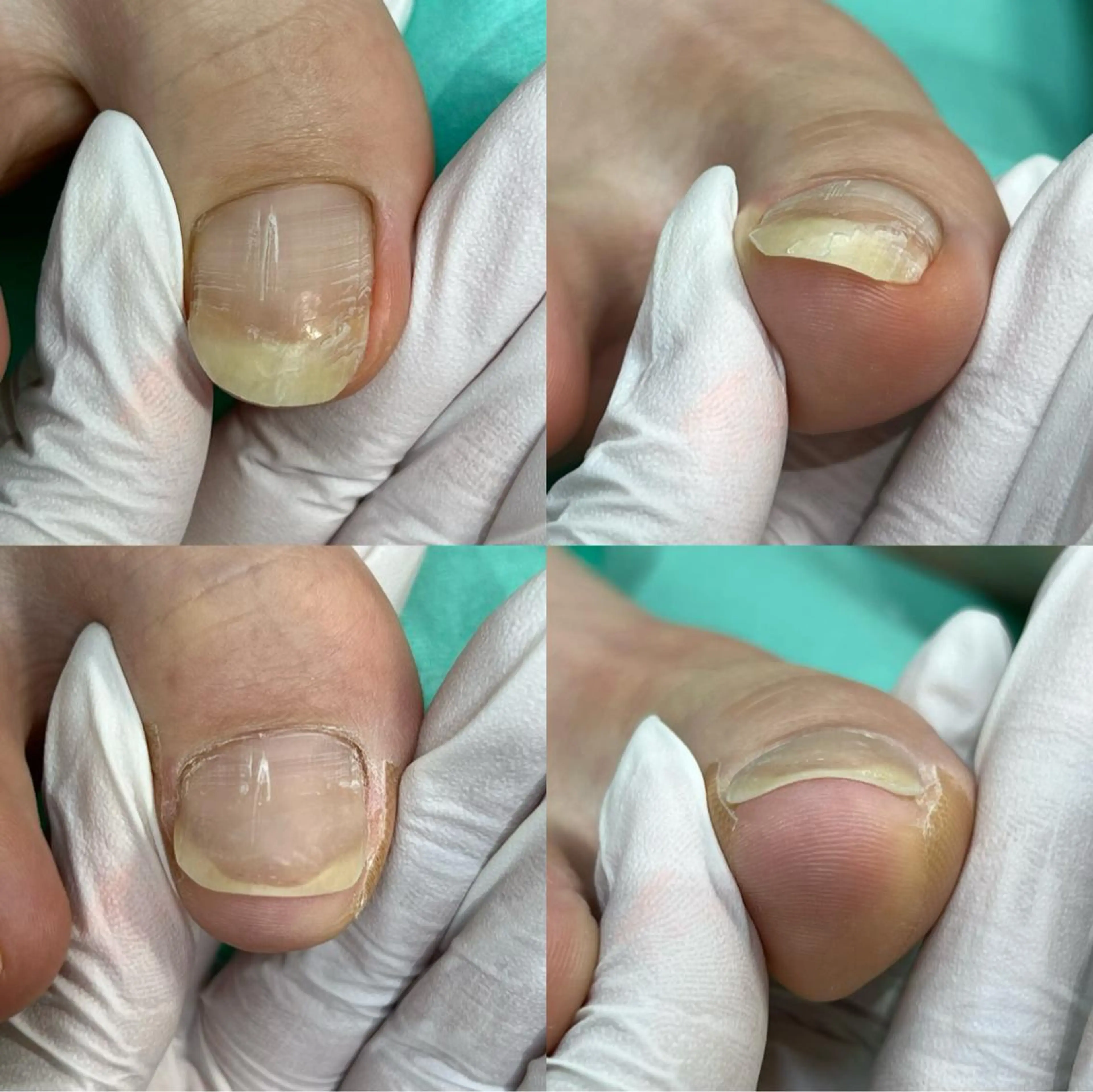 ネイル MAHINA nail所属・MAHINA/ネイル 巻き爪矯正/角質ケアのネイルデザイン