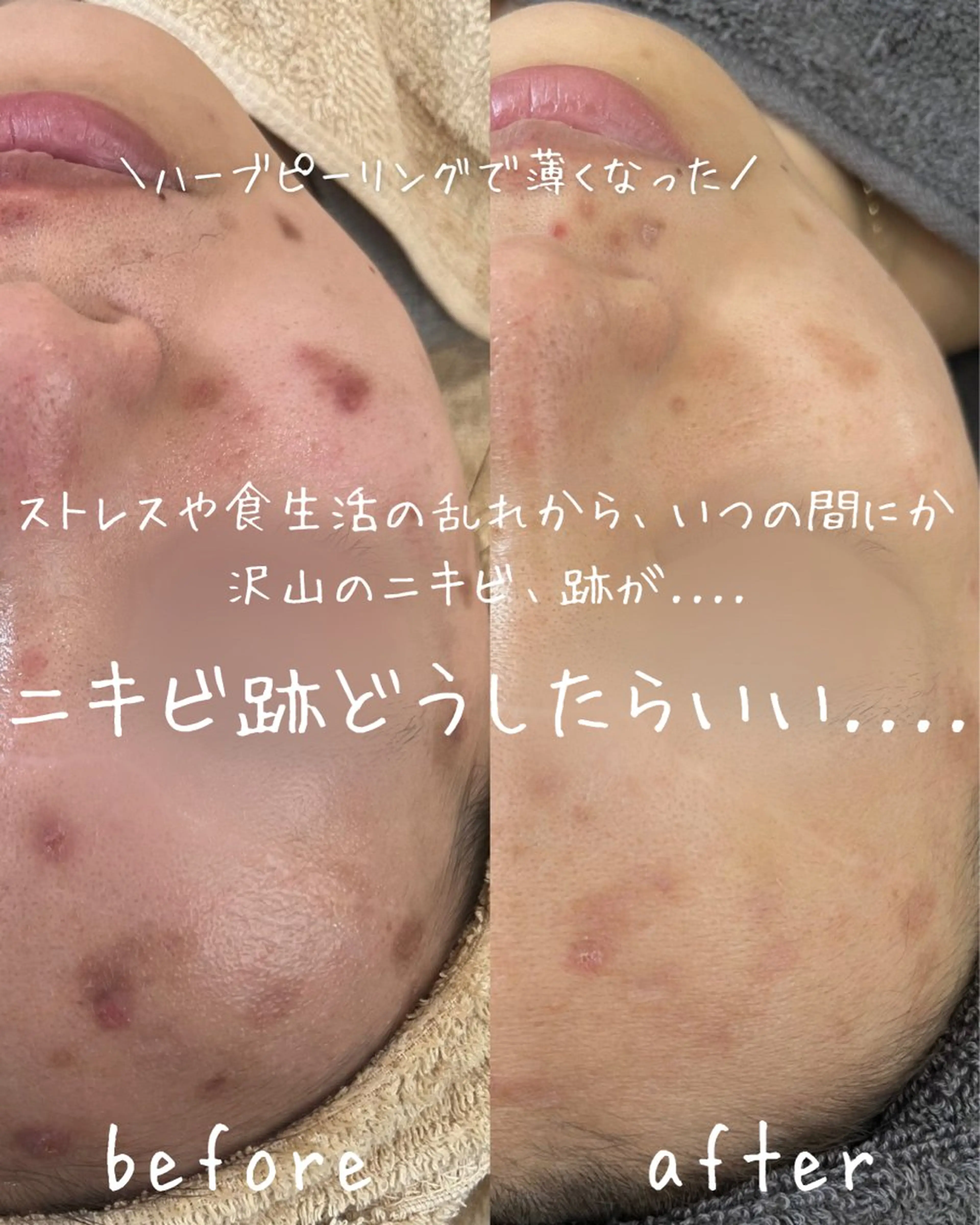 エステ miki 東根の肌質改善サロンのエステ・リラクイメージ