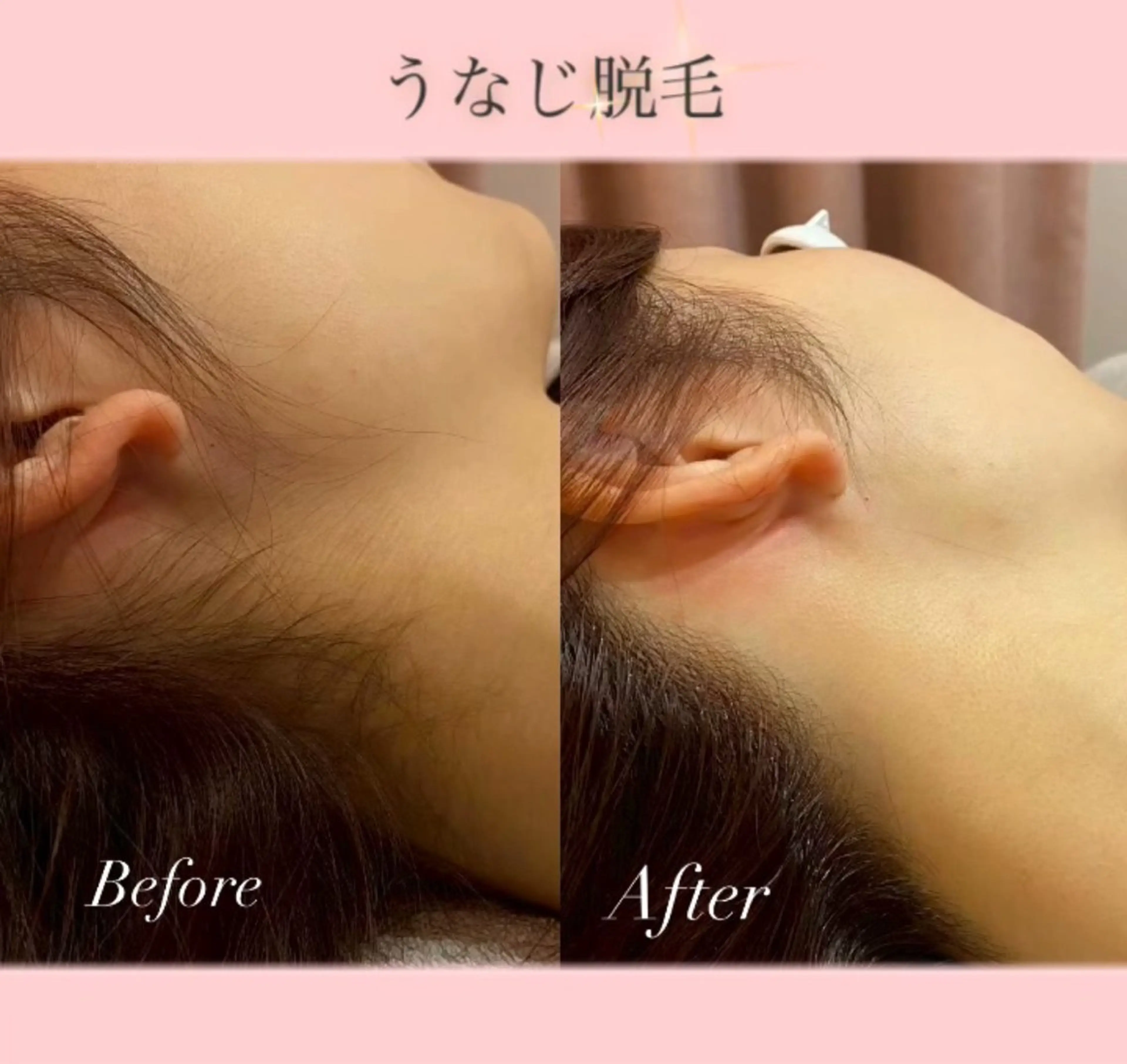 ✨🌷【初回限定価格】うなじ脱毛🌷✨の写真