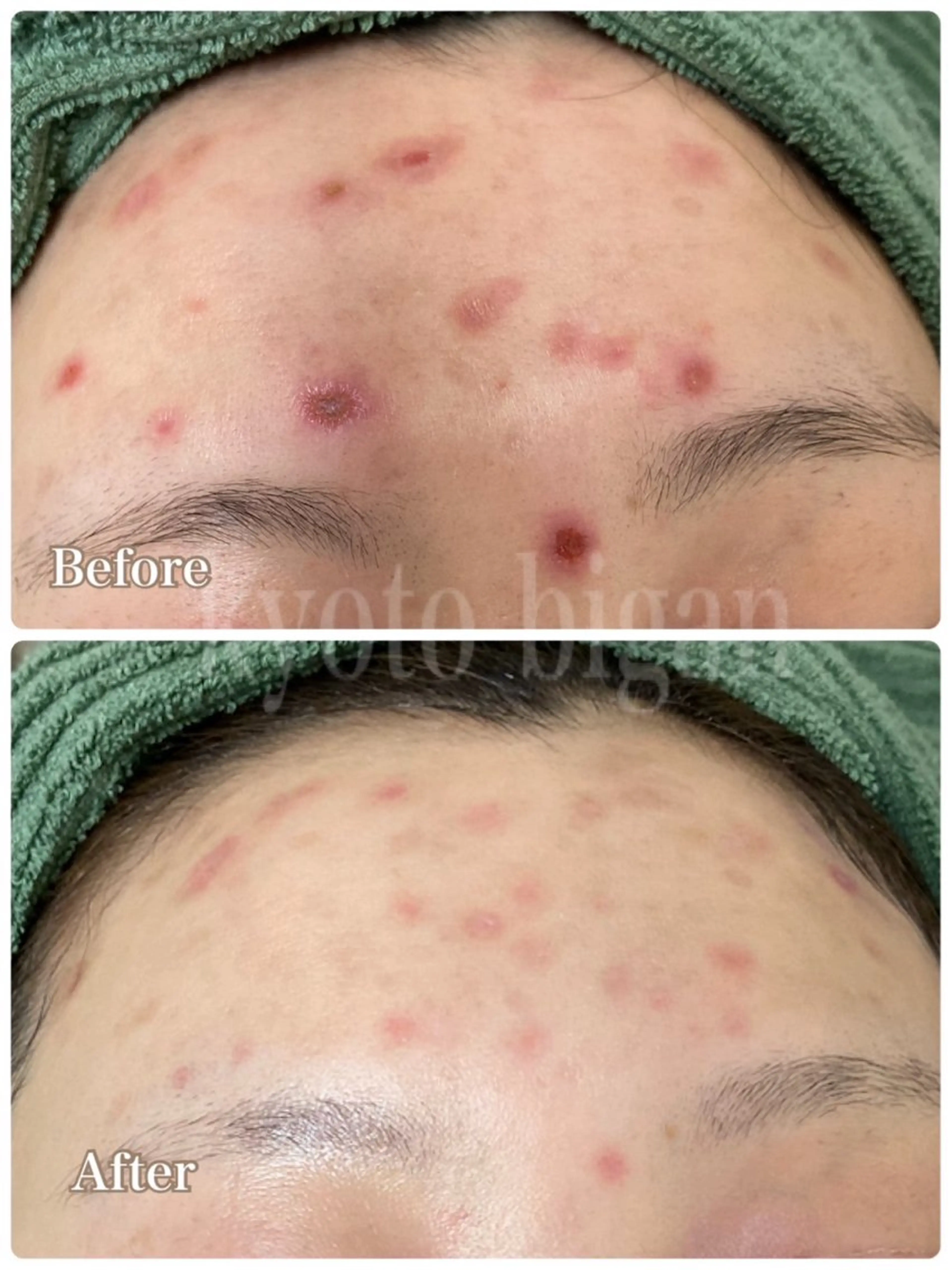 人気No.1きほんのニキビケア⭐️肌悩み解決カウンセリング&ニキビケアフェイシャル体験（８０分）の写真