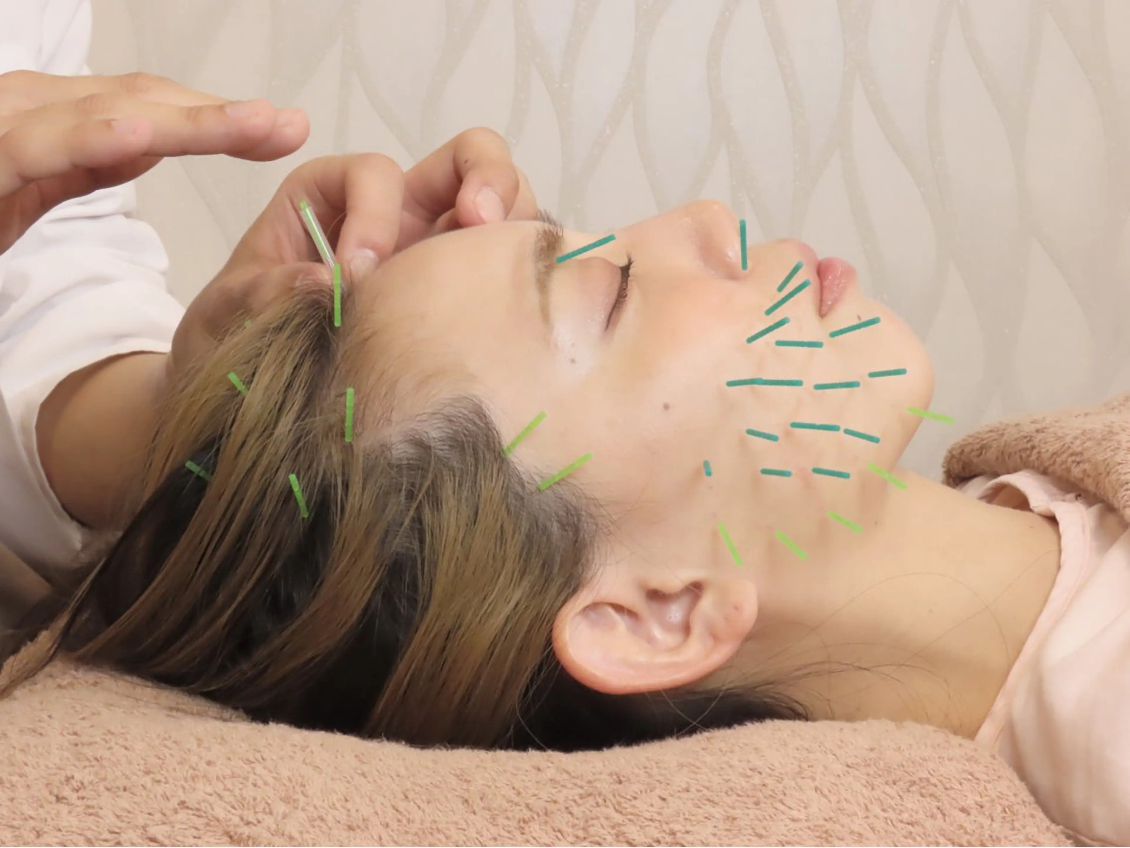 ※口コミ特典あり　【小顔整顔美容鍼】鍼+電気パルスのみ60分の写真