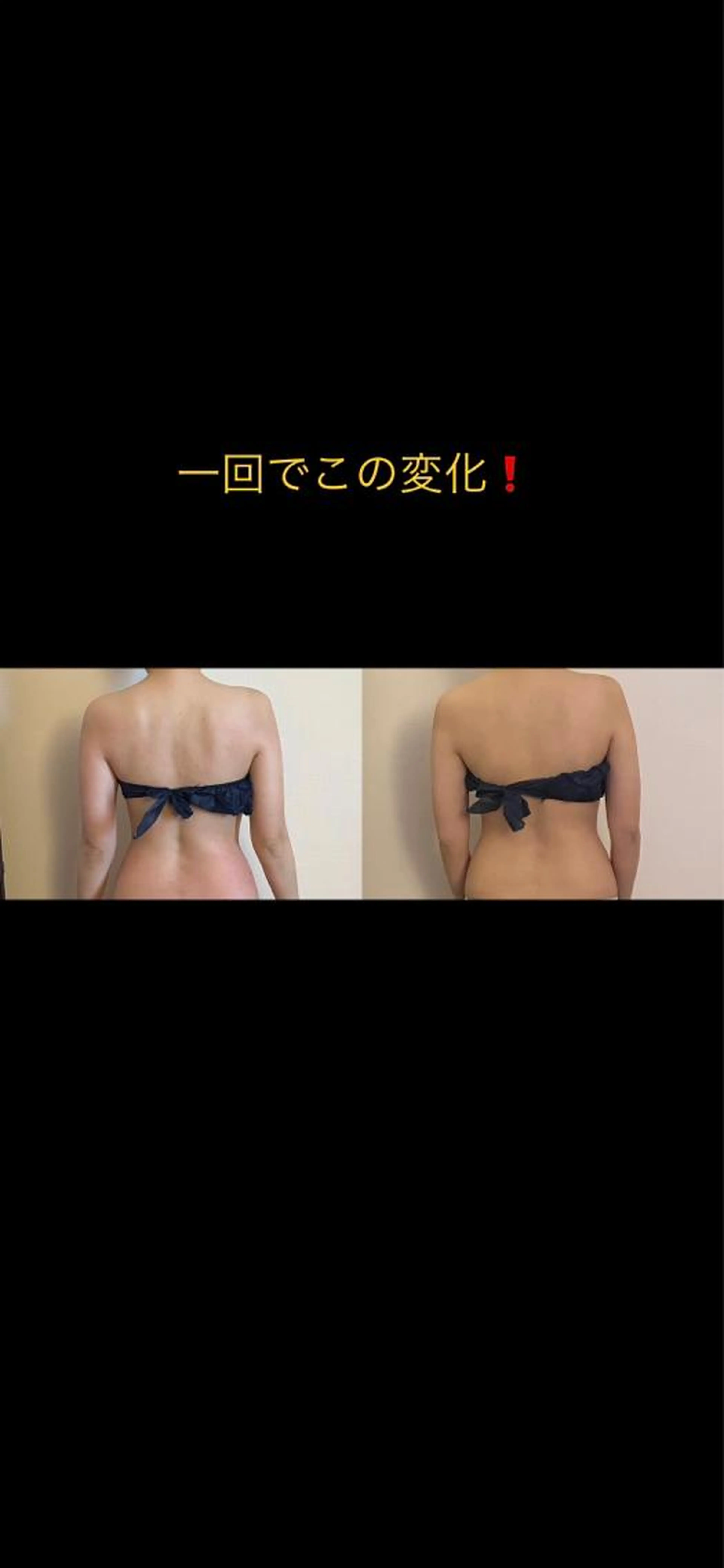 くびれ痩身エステ【キャビテーション】【ラジオ波】【吸引】【ハンドトリートメント】お腹＆背中　60分の写真