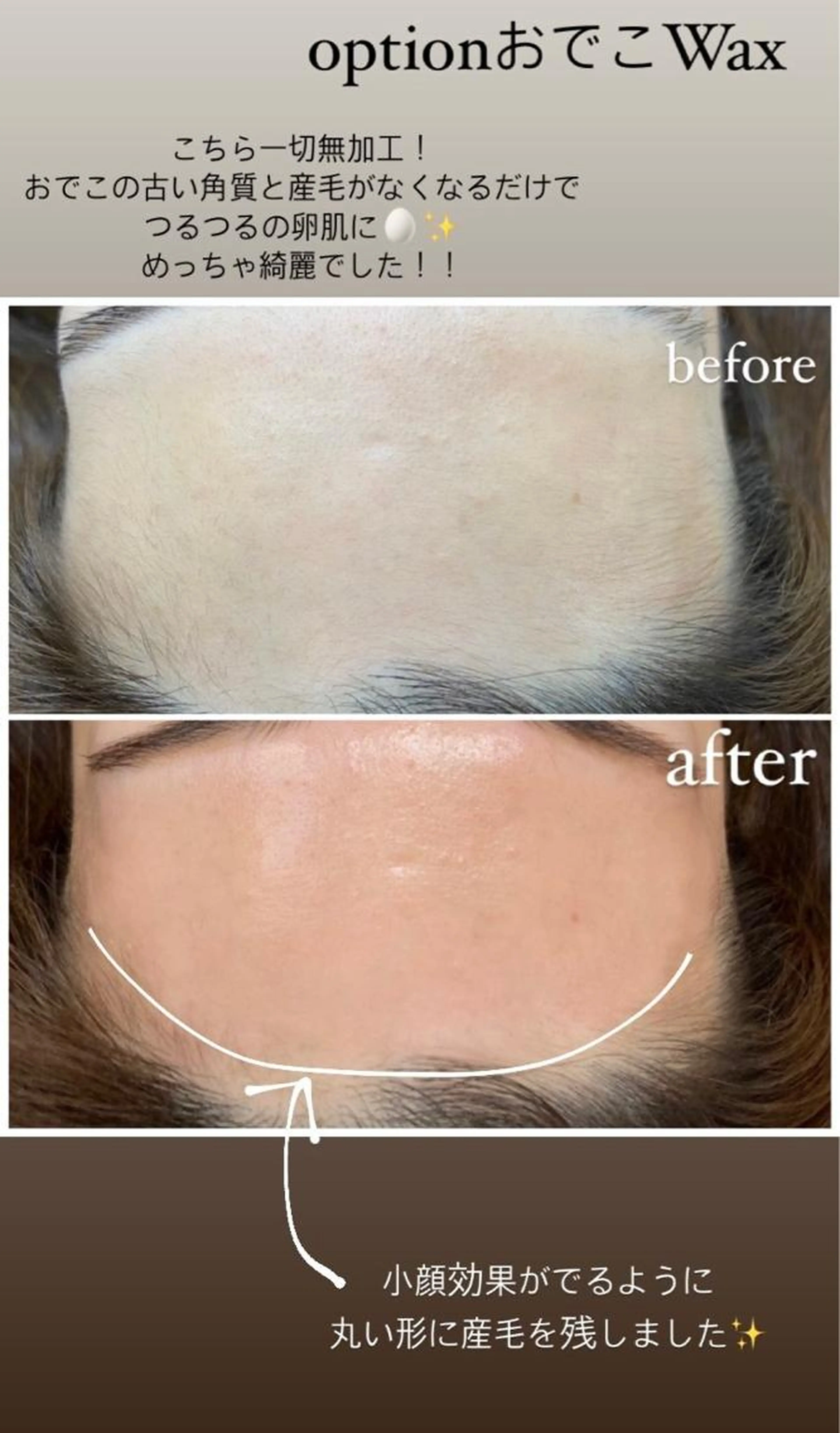 おでこWAX脱毛（オーガニックWAX使用）の写真