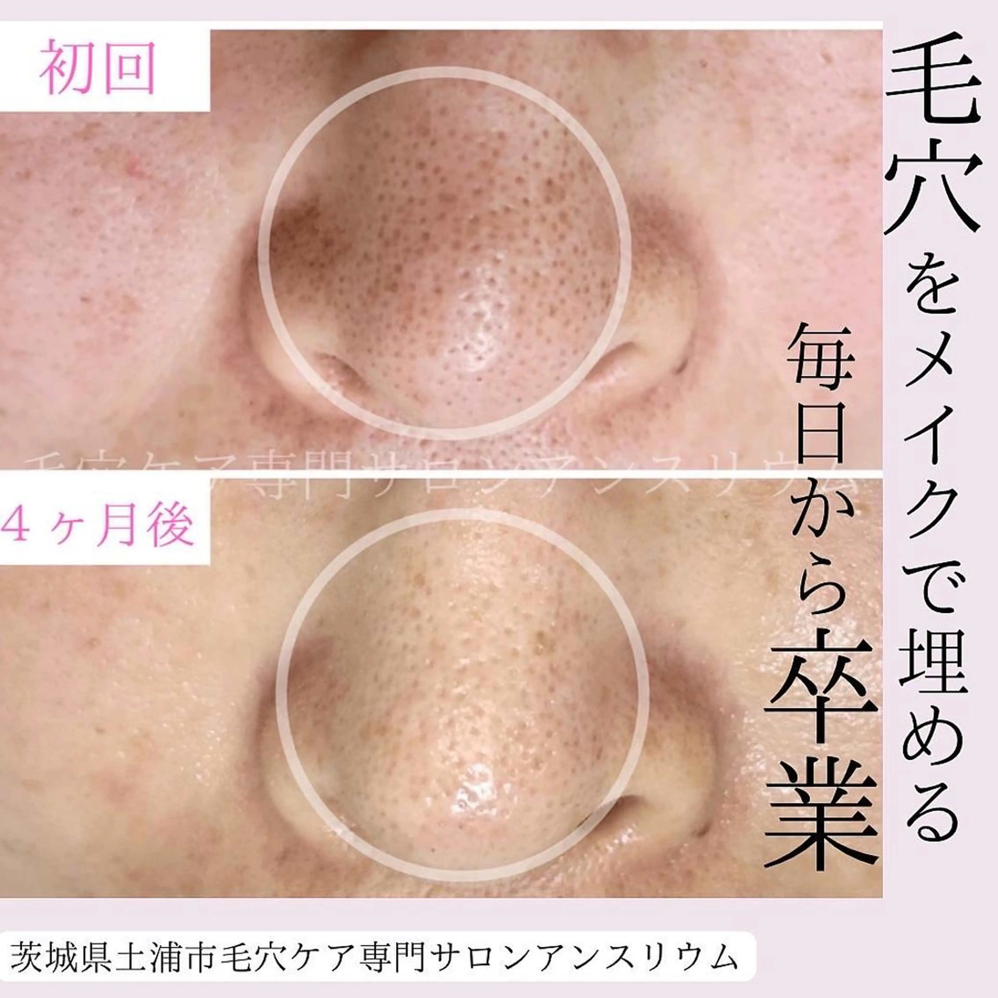 毛穴ケア専門サロンアンスリウム所属・茨城土浦 つくば毛穴 ケア専門サロンのエステ・リラクイメージ