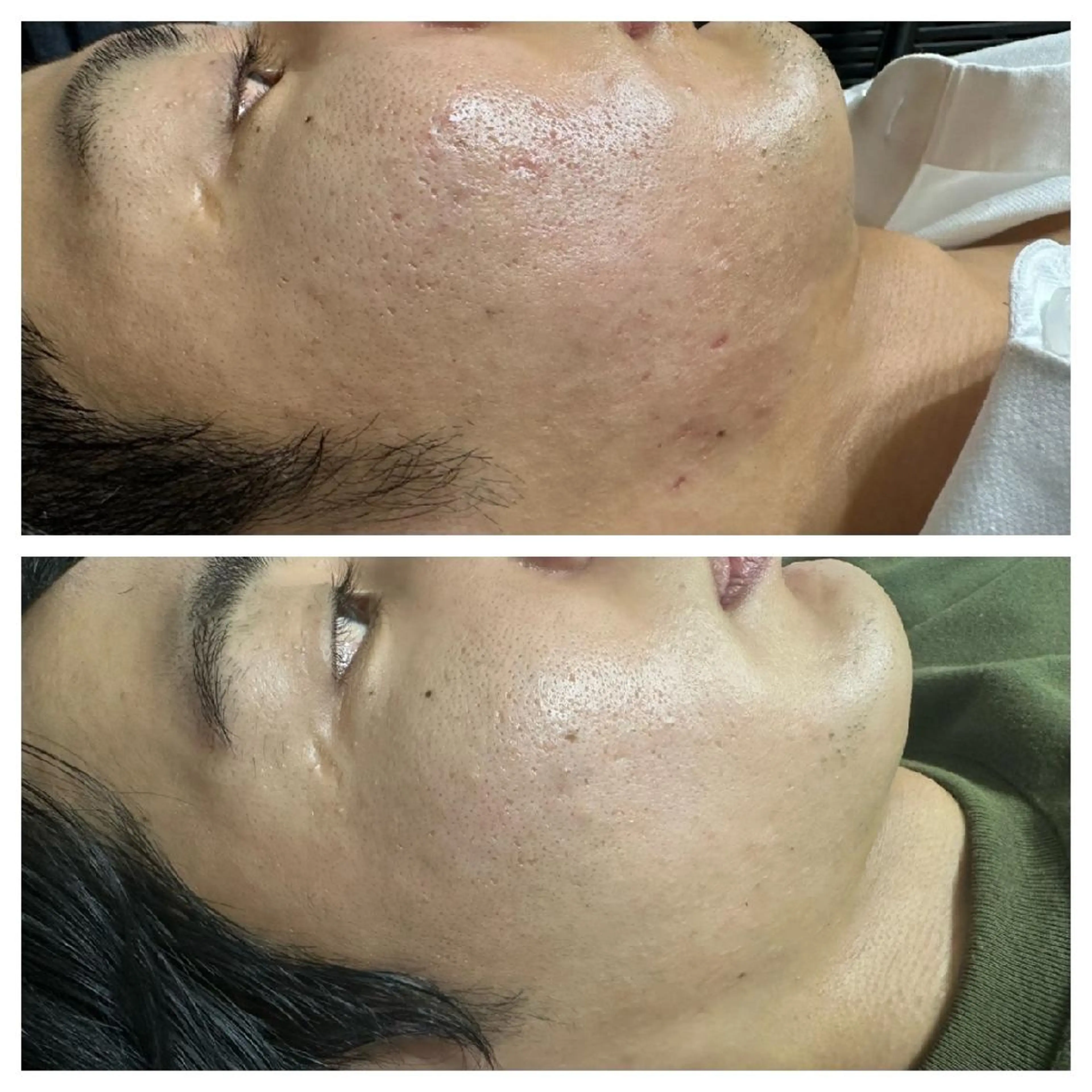 【とにかく肌を綺麗にしたい人ミニモ学割】ハーブピーリング+毛穴洗浄の写真