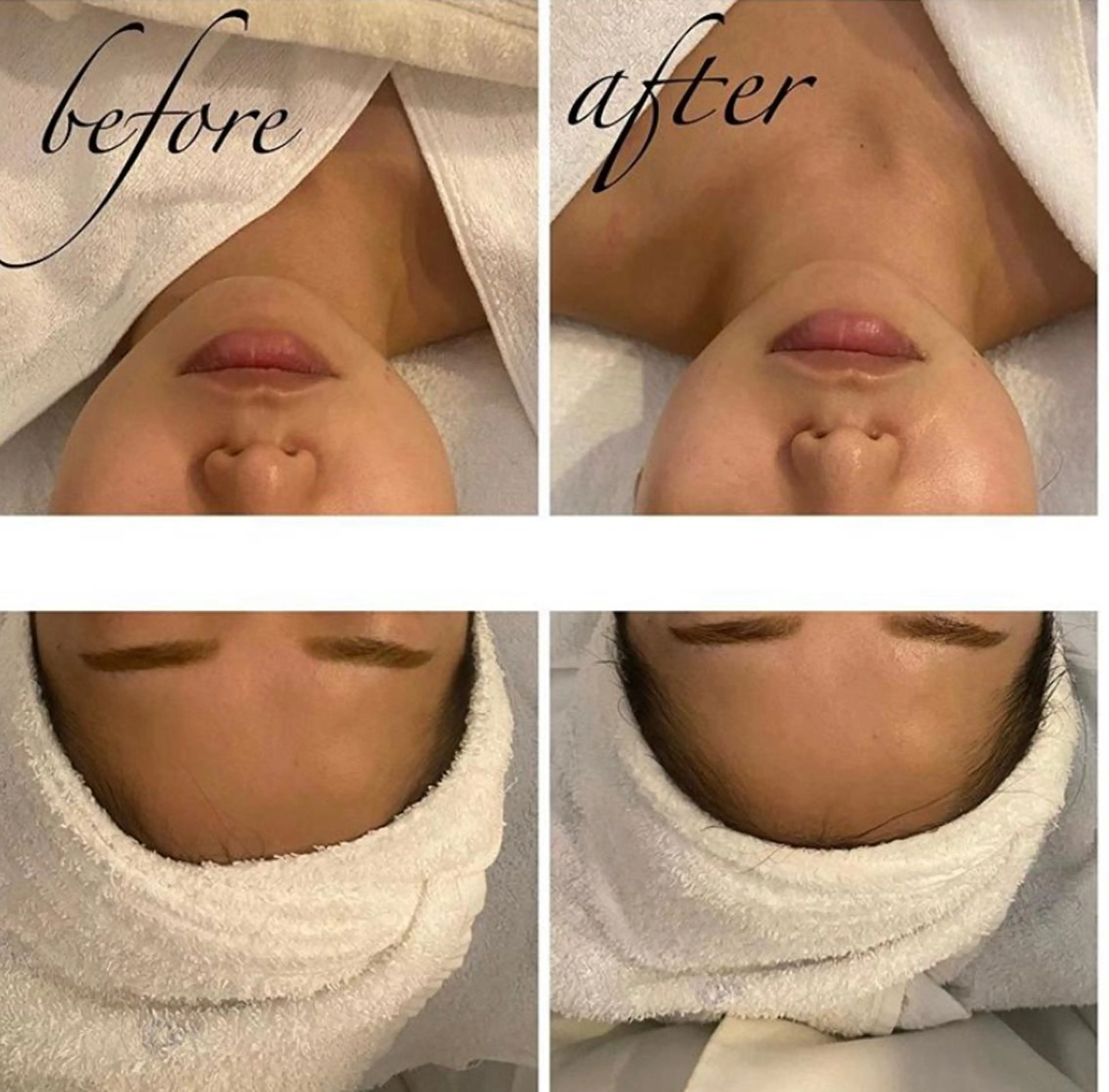 エステ リラク 毛穴/ピーリング ララピール/POLAのエステ・リラクイメージ