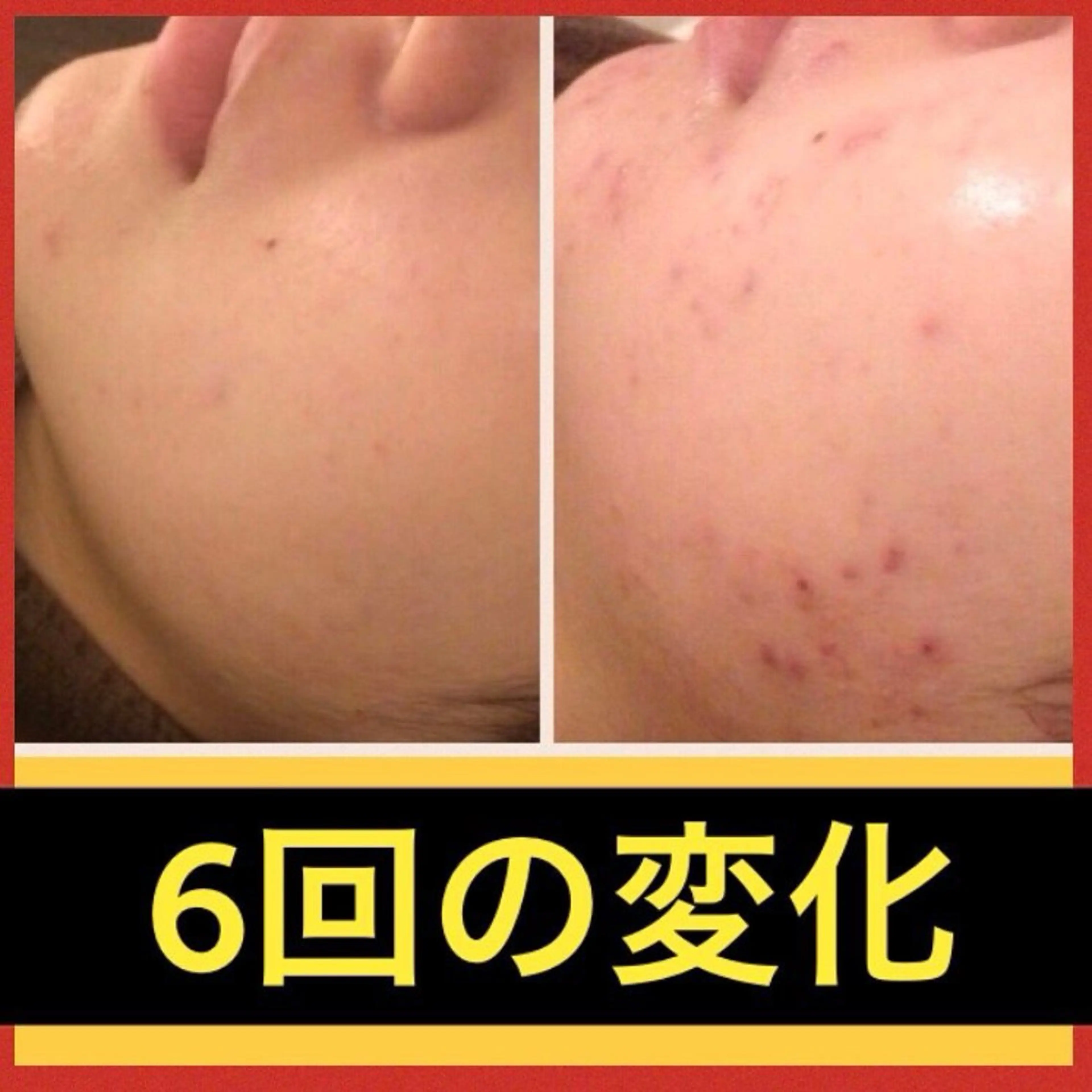 学生ニキビ改善🍀 優しい肌質改善のエステ・リラクイメージ