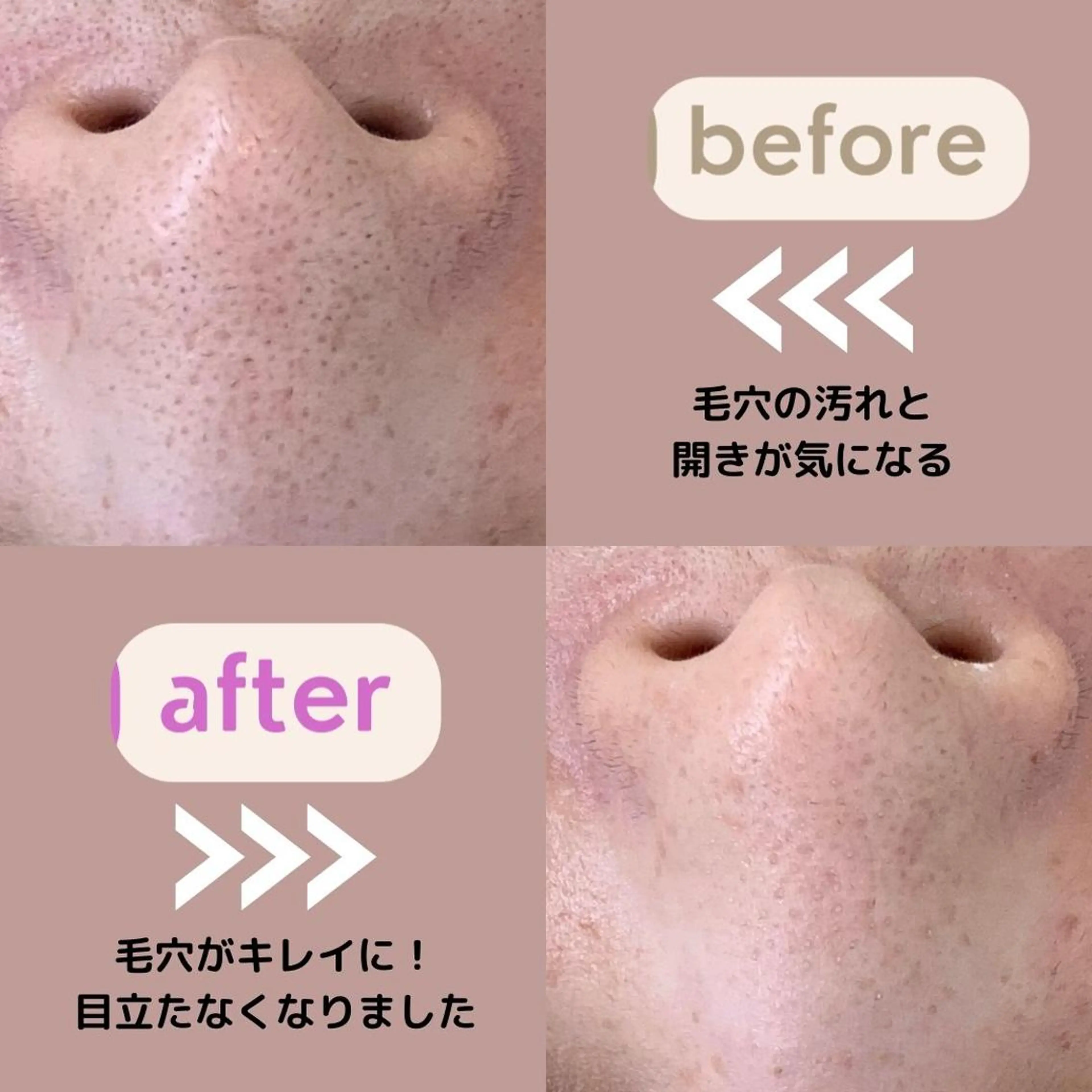 【毛穴ケア◎】フェイシャルピーリングコース75分 肌悩みに合わせたパックと美容液でお肌をしっかりトリートメントの写真