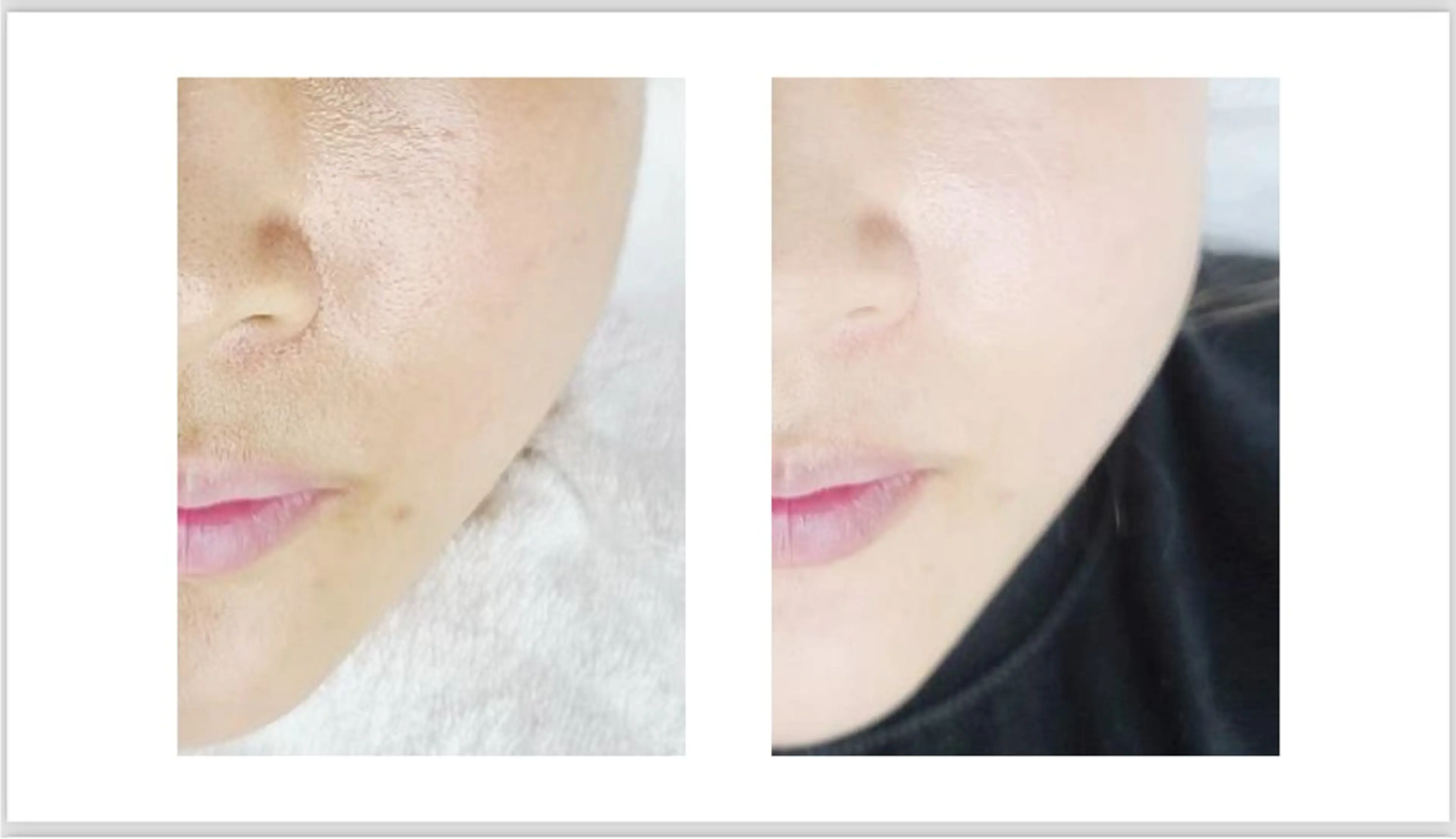 【韓国で話題沸騰中!!】韓国最新美容/水光/ララピールコース初回限定￥9,800の写真