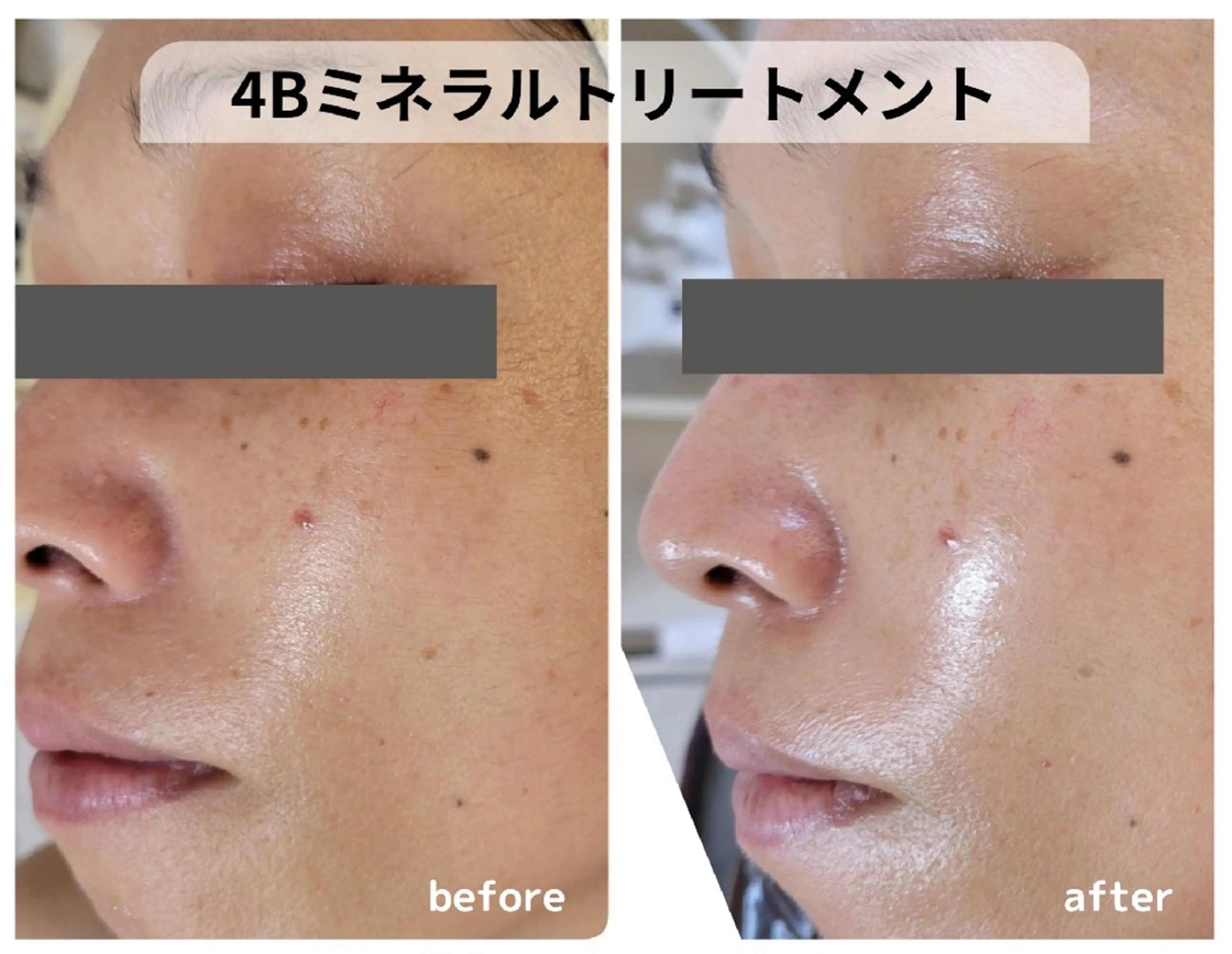 4Bミネラルトリートメント(ハーブピーリング)の写真