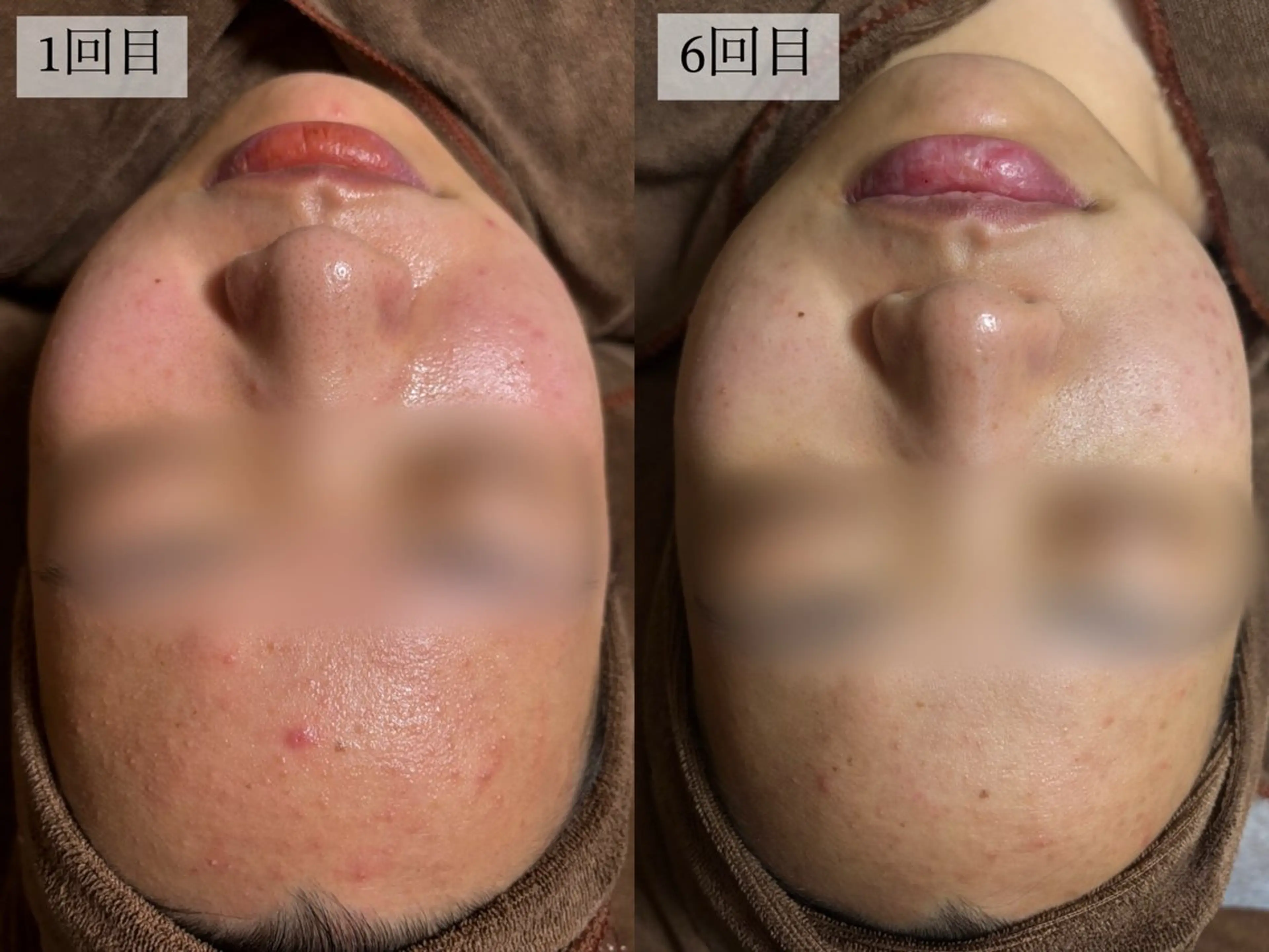 エステ HINANO矢場町店【ヒナノ】所属・脱毛/肌改善🌿 HINANO 村田のエステ・リラクイメージ