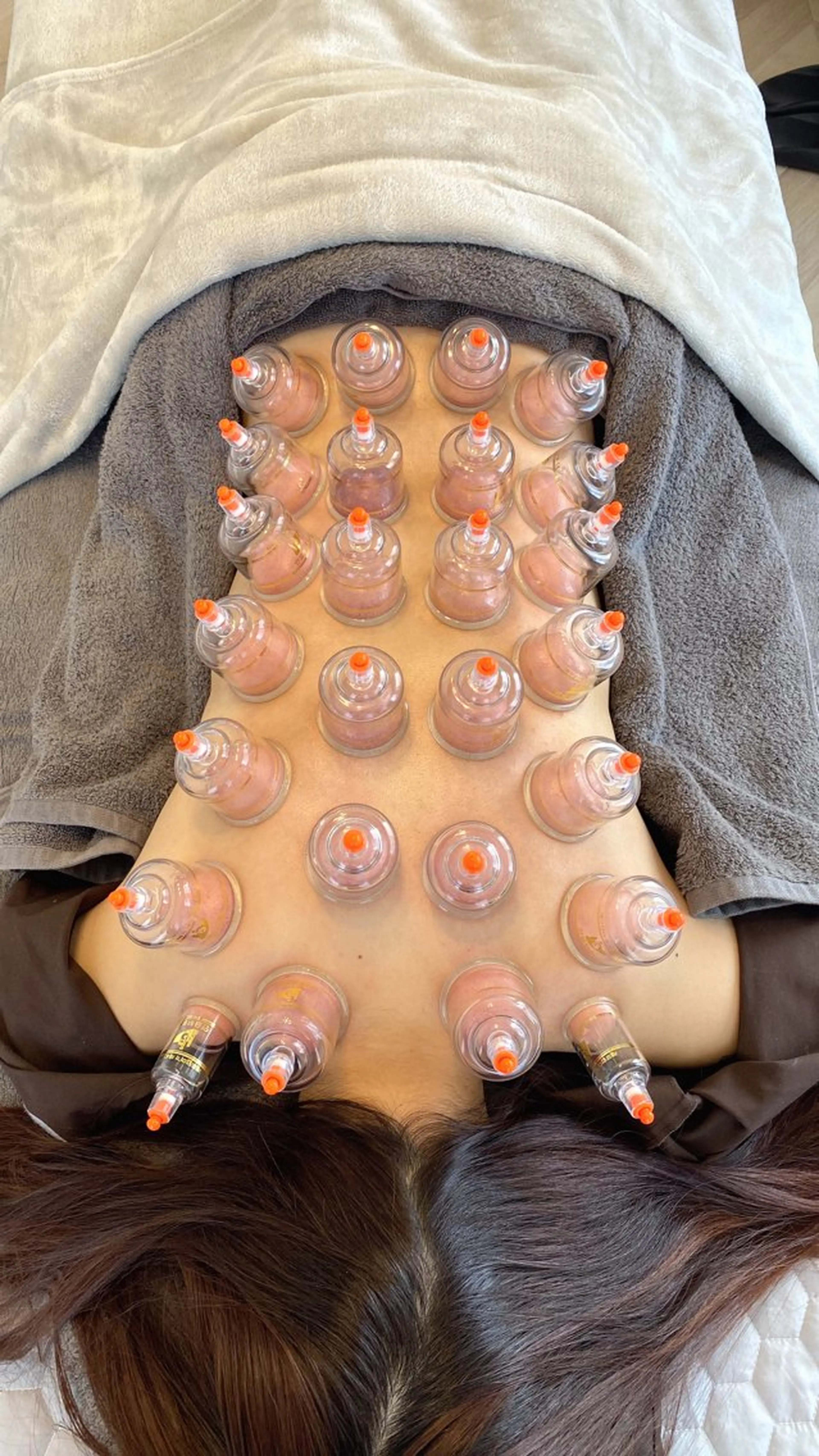 🌟むくみ撃退👋🏻定番の吸い玉‼️足と背中すっきりカッピング😌🌿の写真