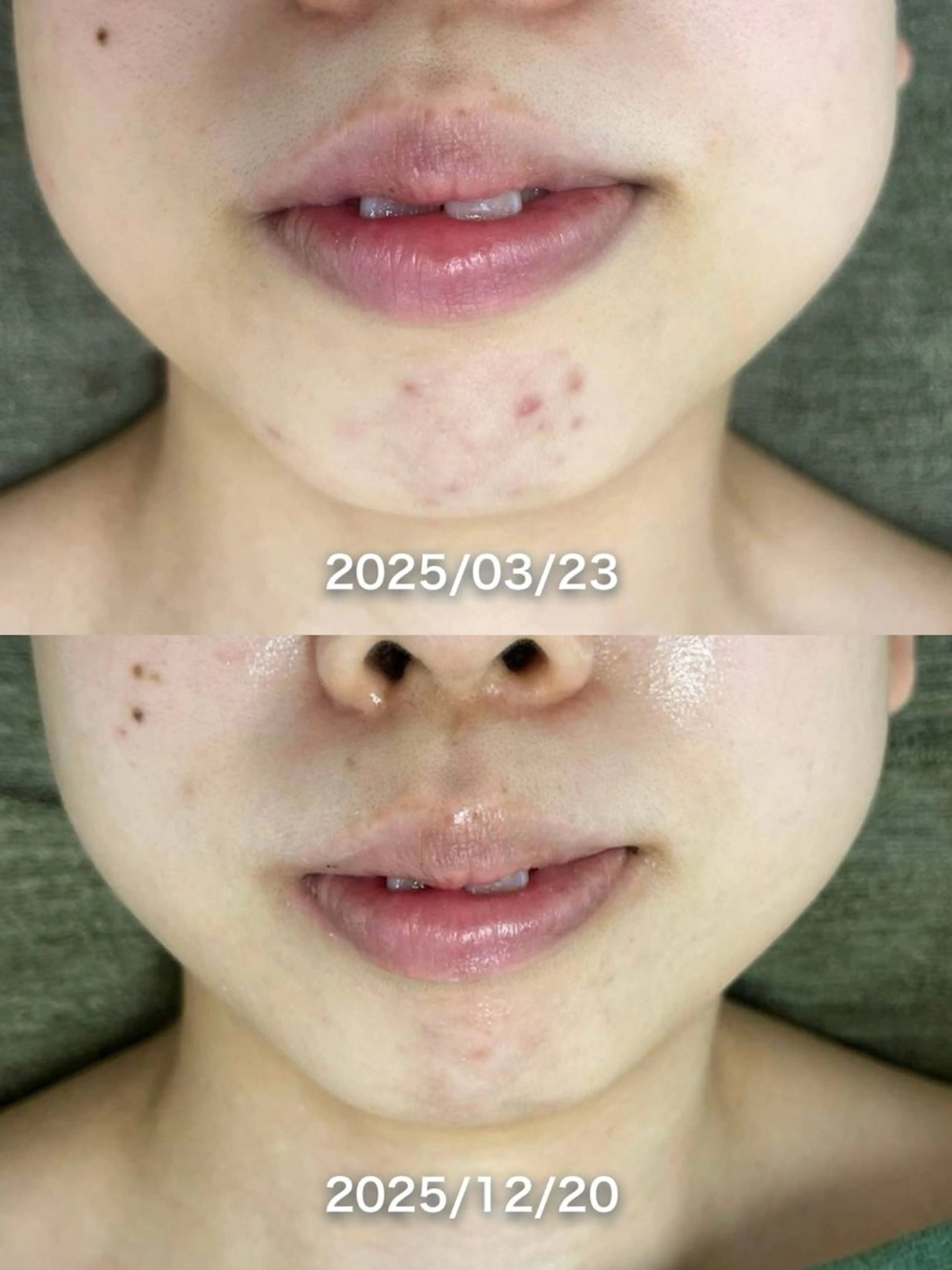 エステ 韓国美肌/肌質改善 【天神】yuiのエステ・リラクイメージ