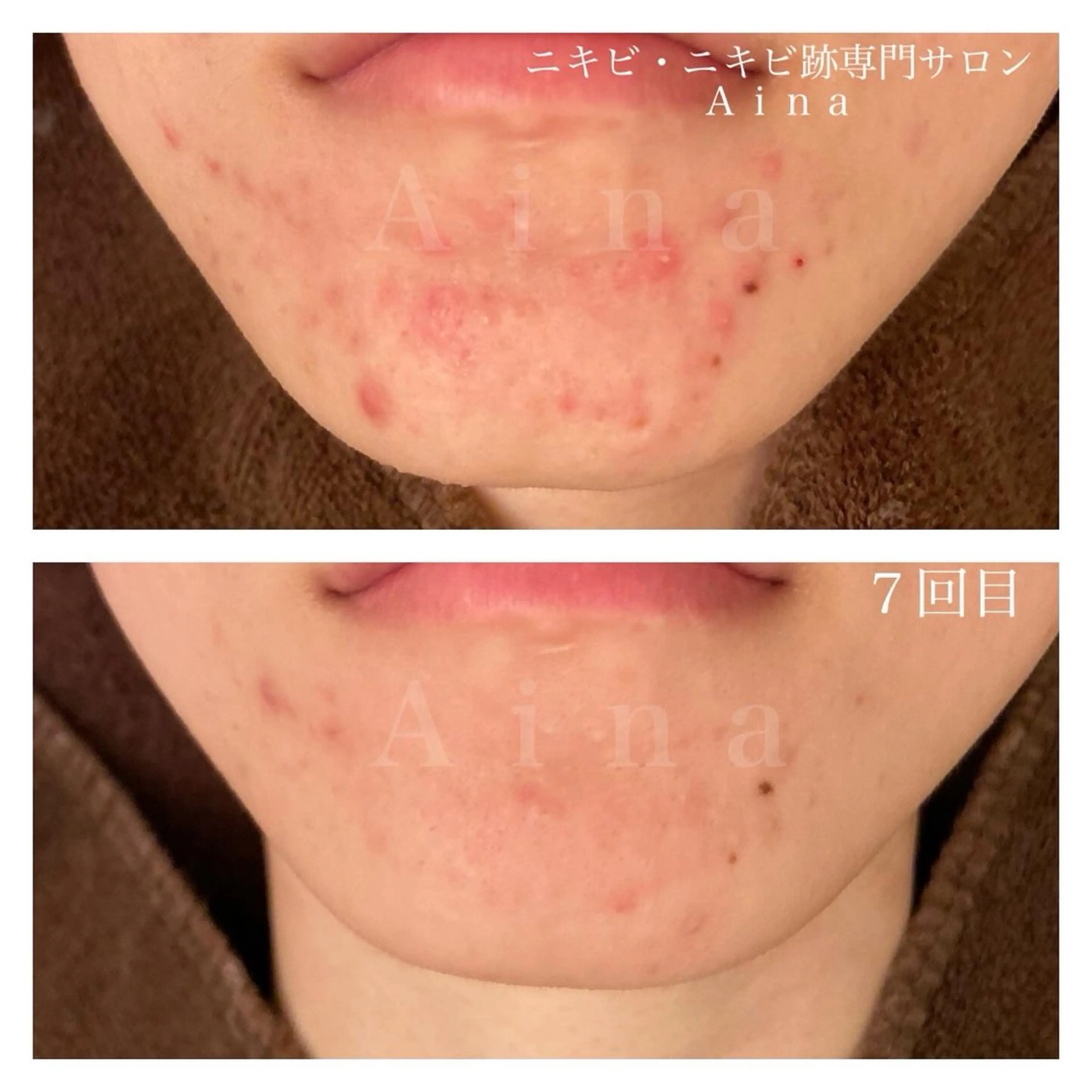 エステ リラク ニキビ跡専門サロン Ａｉｎａのエステ・リラクイメージ