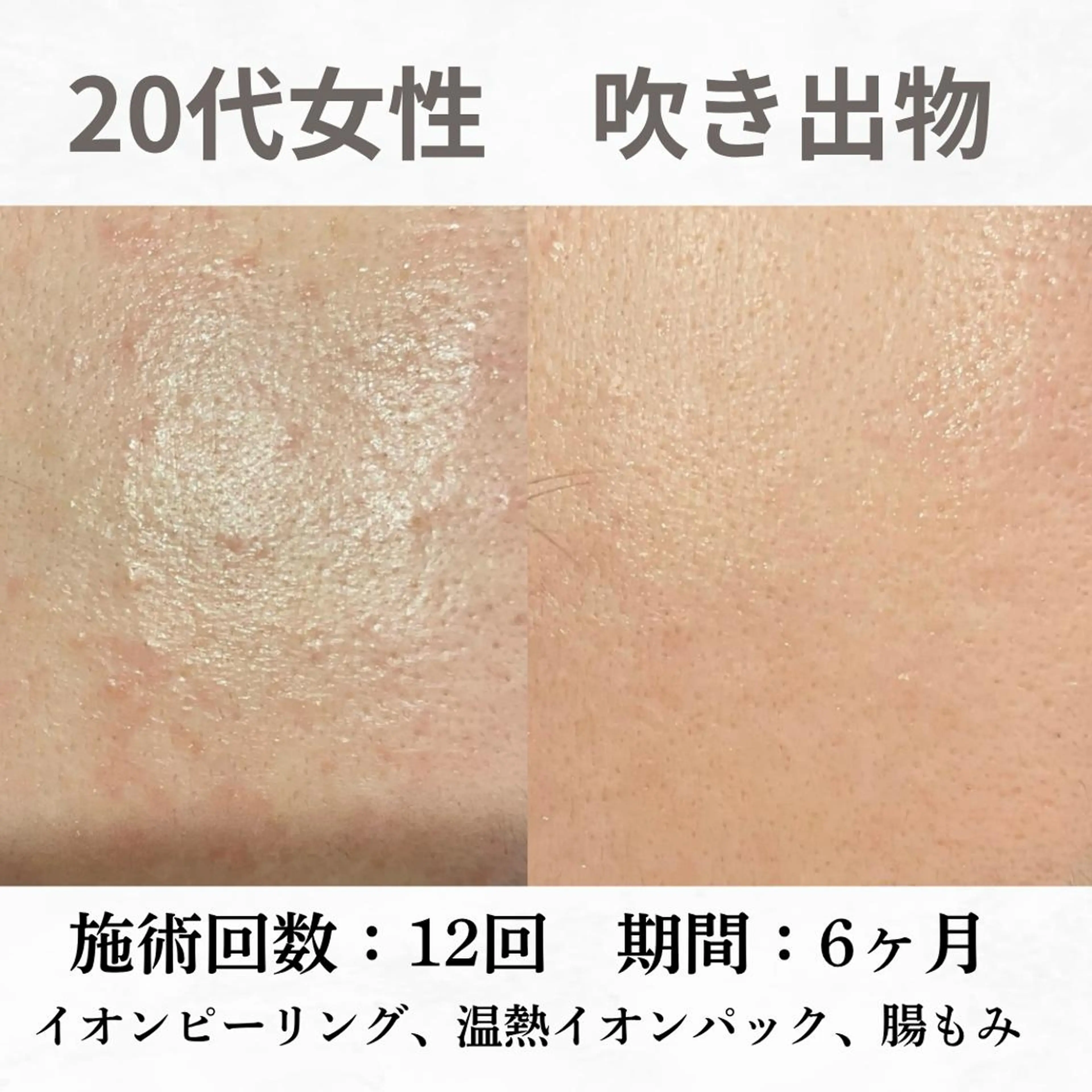 重度ニキビ専門🌷 ダウンタイムなしのエステ・リラクイメージ