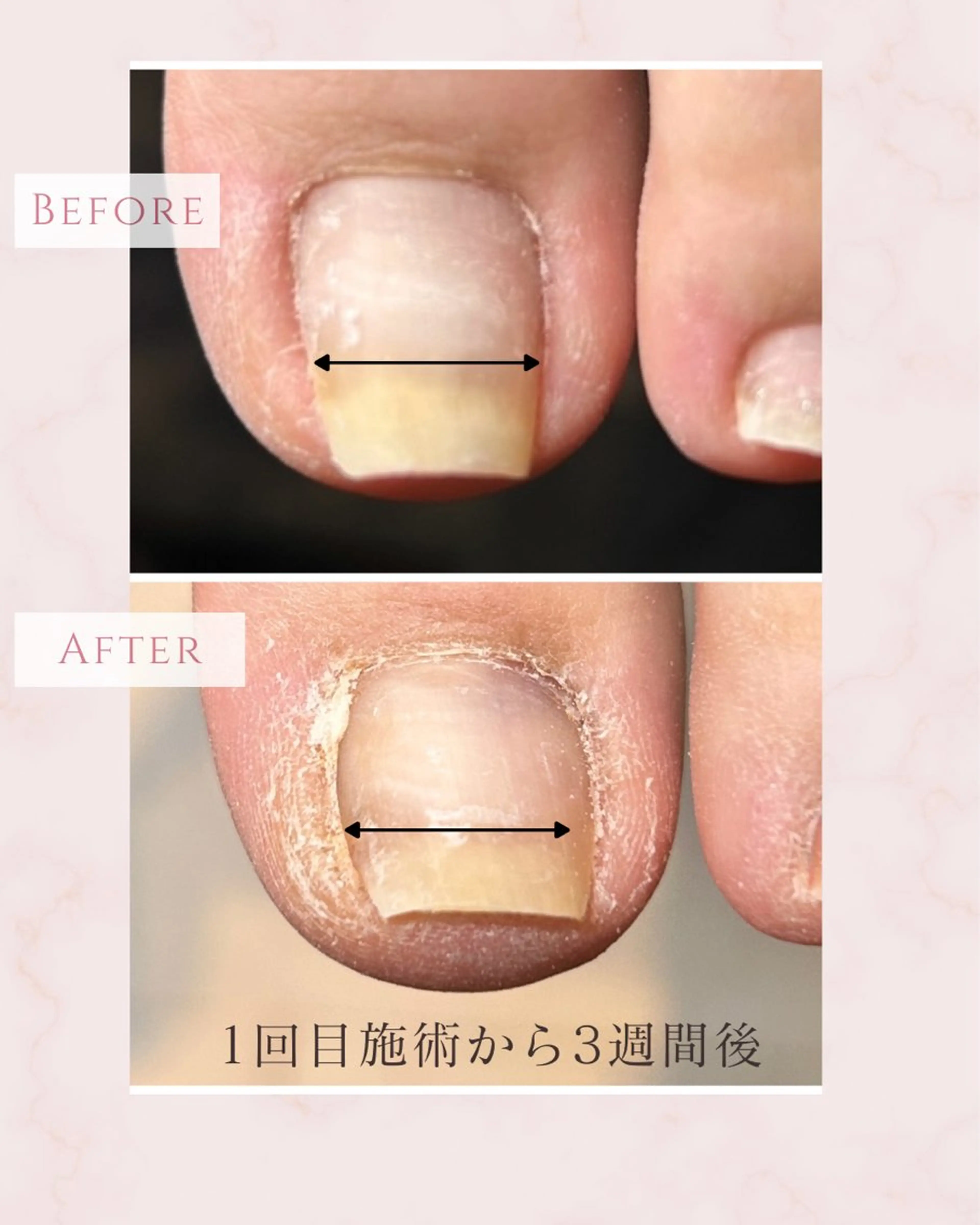 ネイル 春ネイル その他(ネイル) N.style所属・Ｎ. styleのネイルデザイン