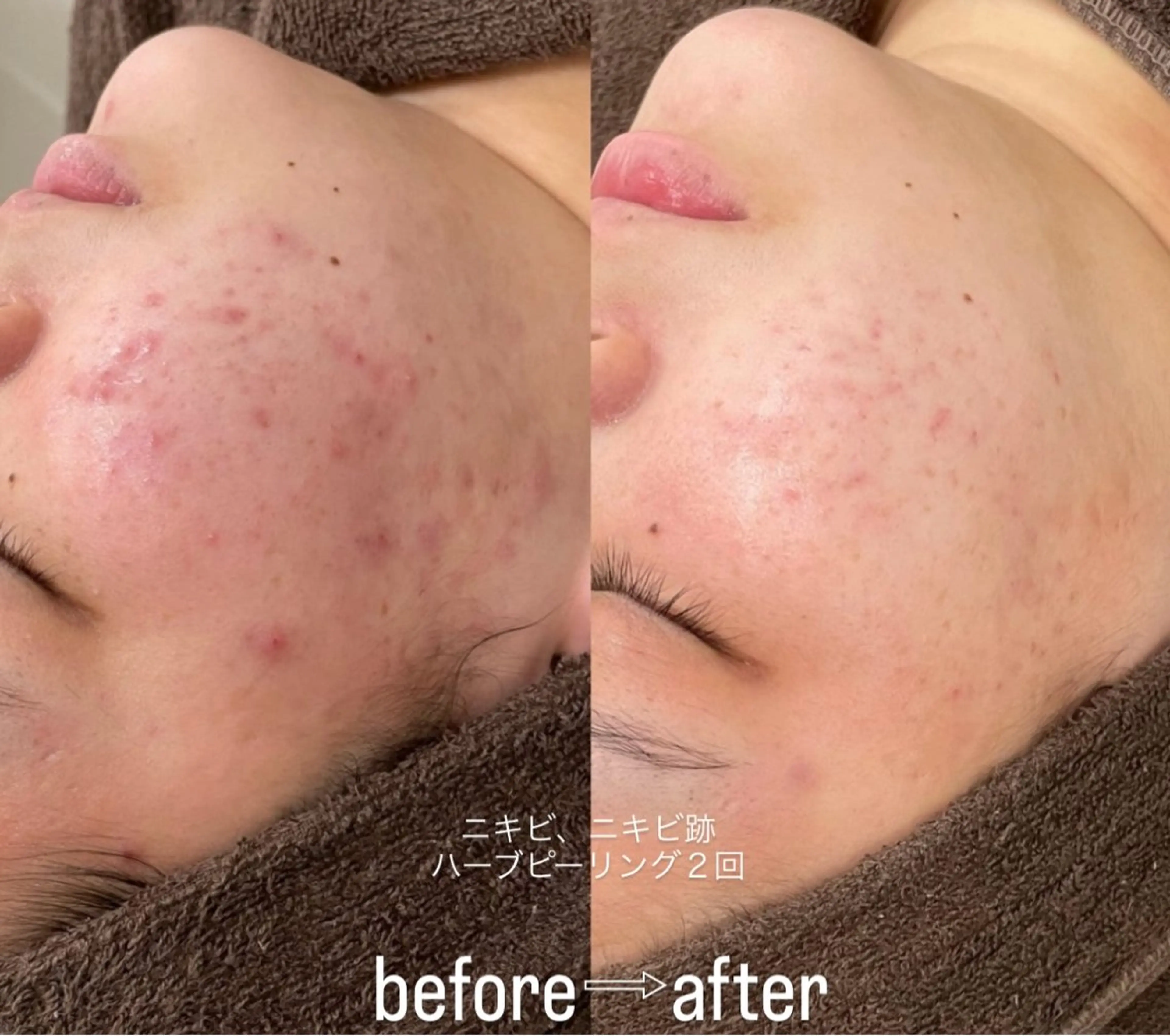 [ニキビ、ニキビ跡お悩みの方]韓国産🇰🇷剥離アリハーブピーリング🌿の写真