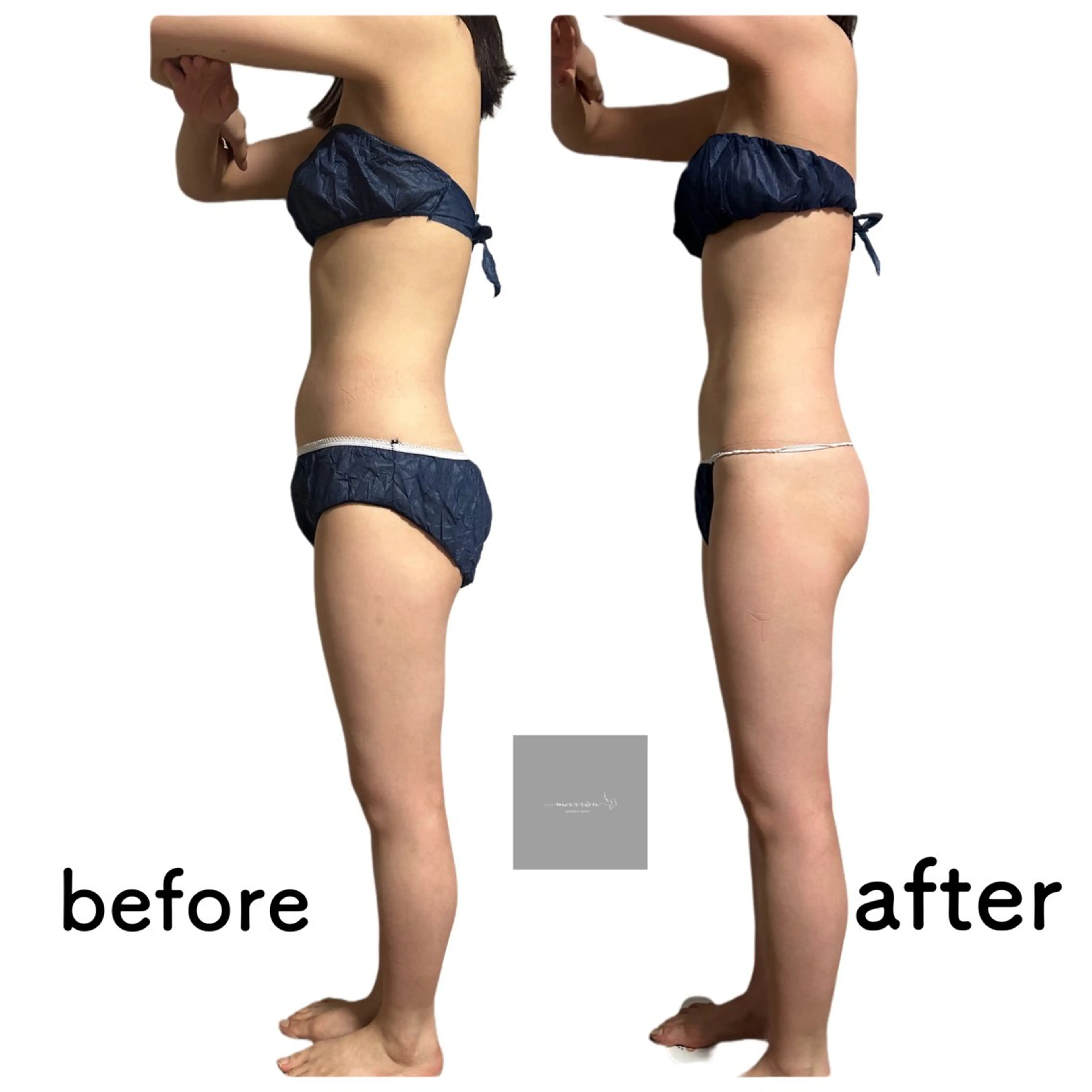 エステ リラク marron所属・痩身ハイパーナイフ ララピールリアボーテのエステ・リラクイメージ