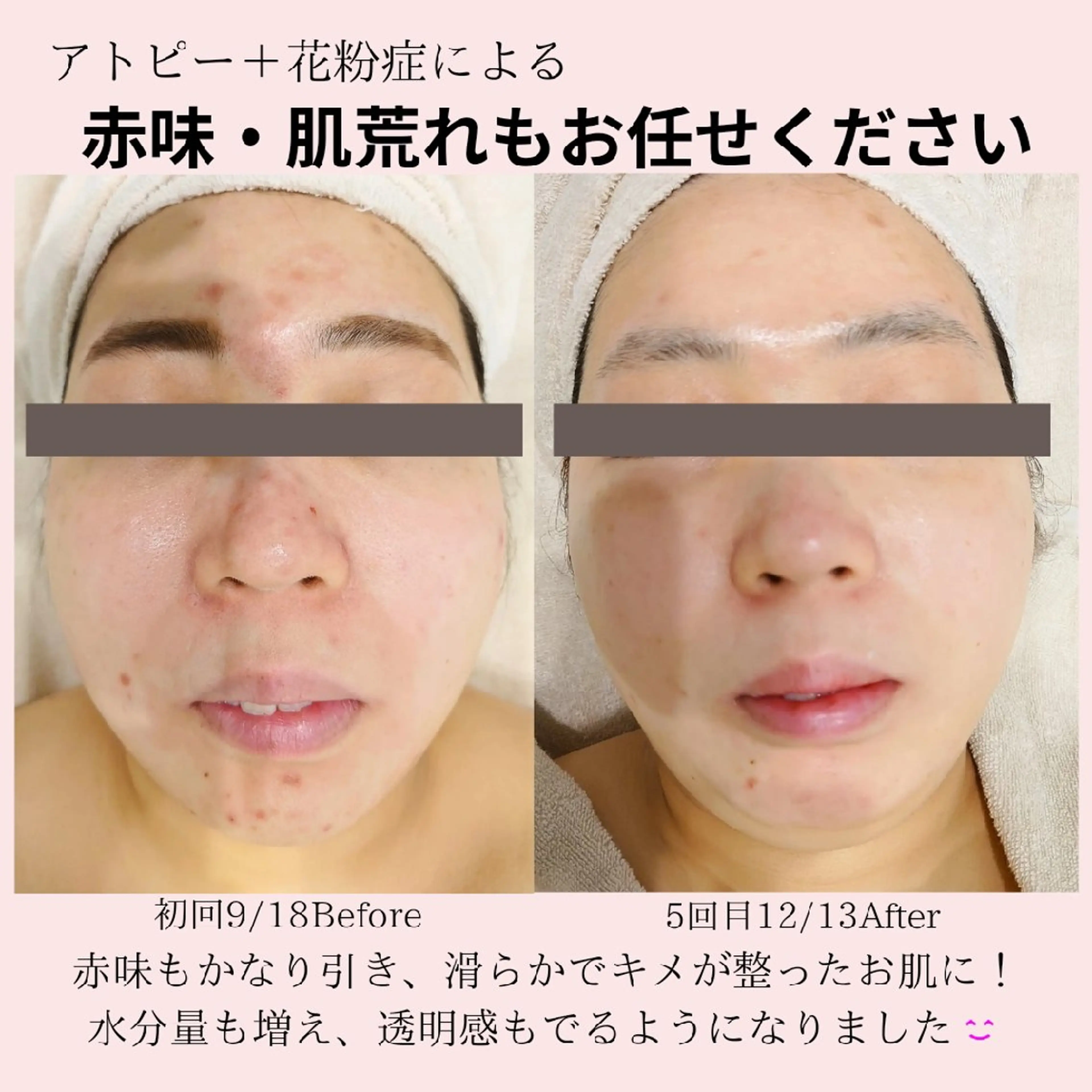 エステ PRETTIEST SHINE所属・山田 浩子のエステ・リラクイメージ