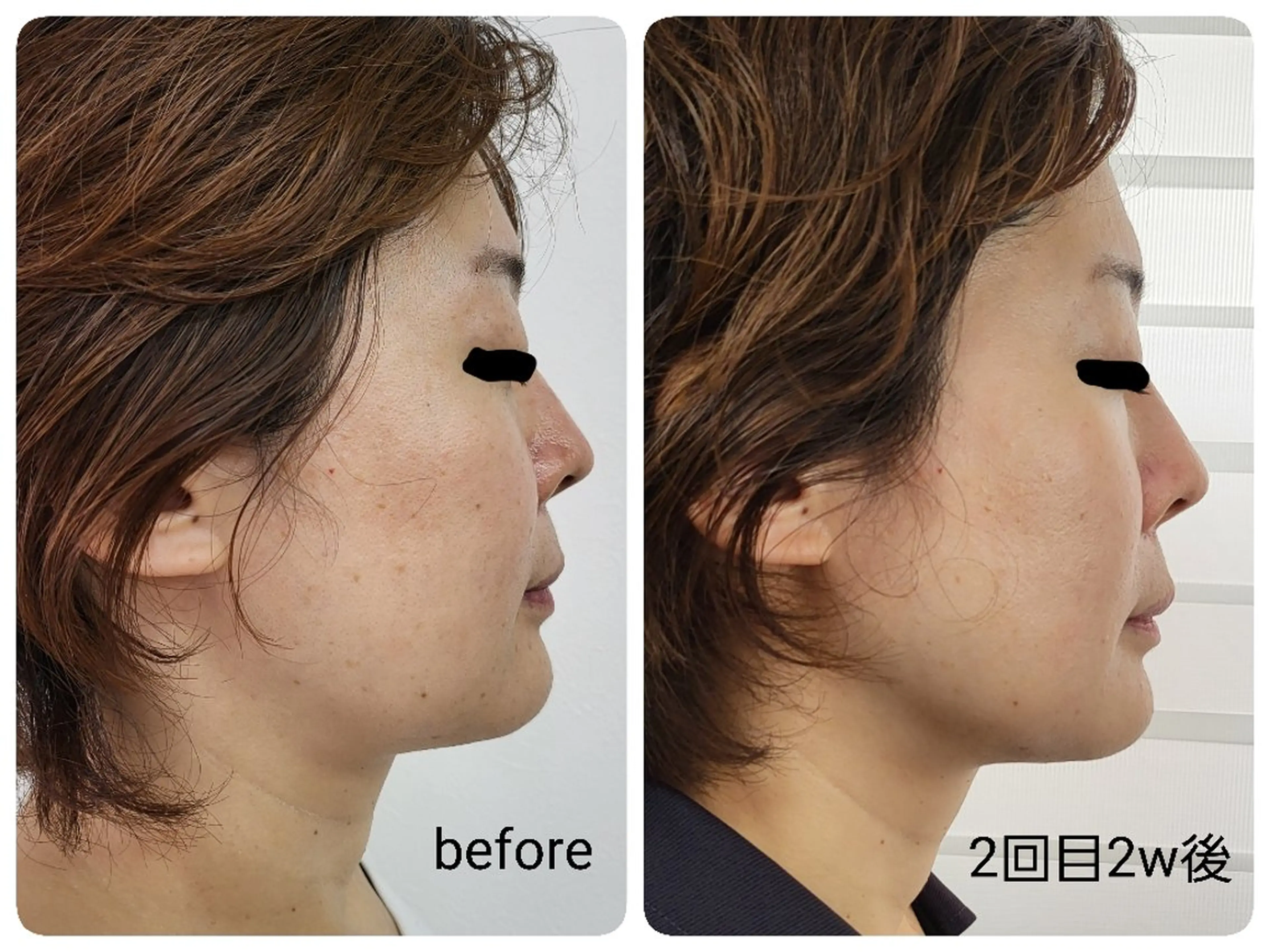 エステ レチノール/ニキビ/ 毛穴ケア　浅川のエステ・リラクイメージ