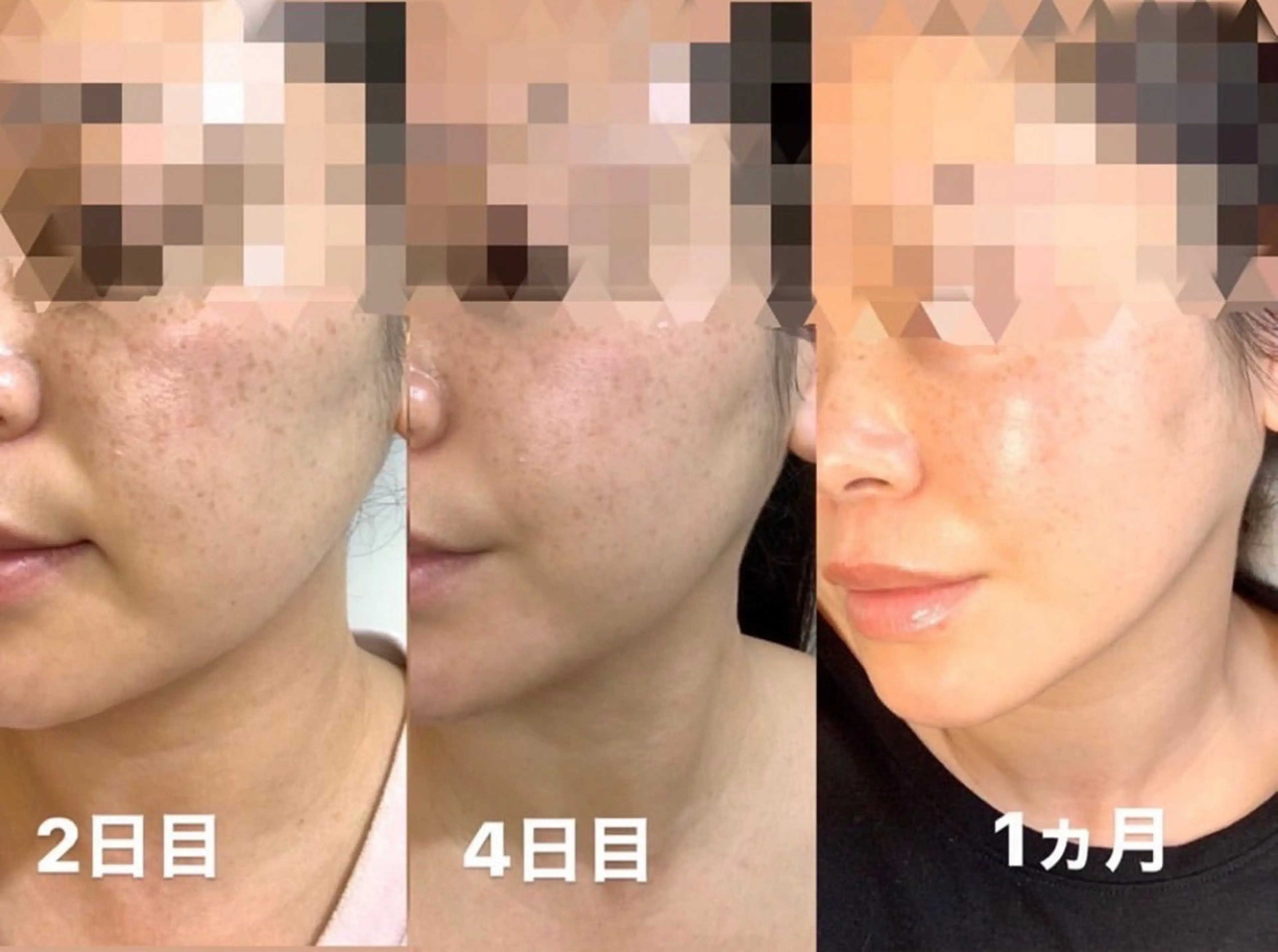 【毛穴の黒ずみ、汚れ吸引】艶々お肌が手に入る炭酸パック付きの写真