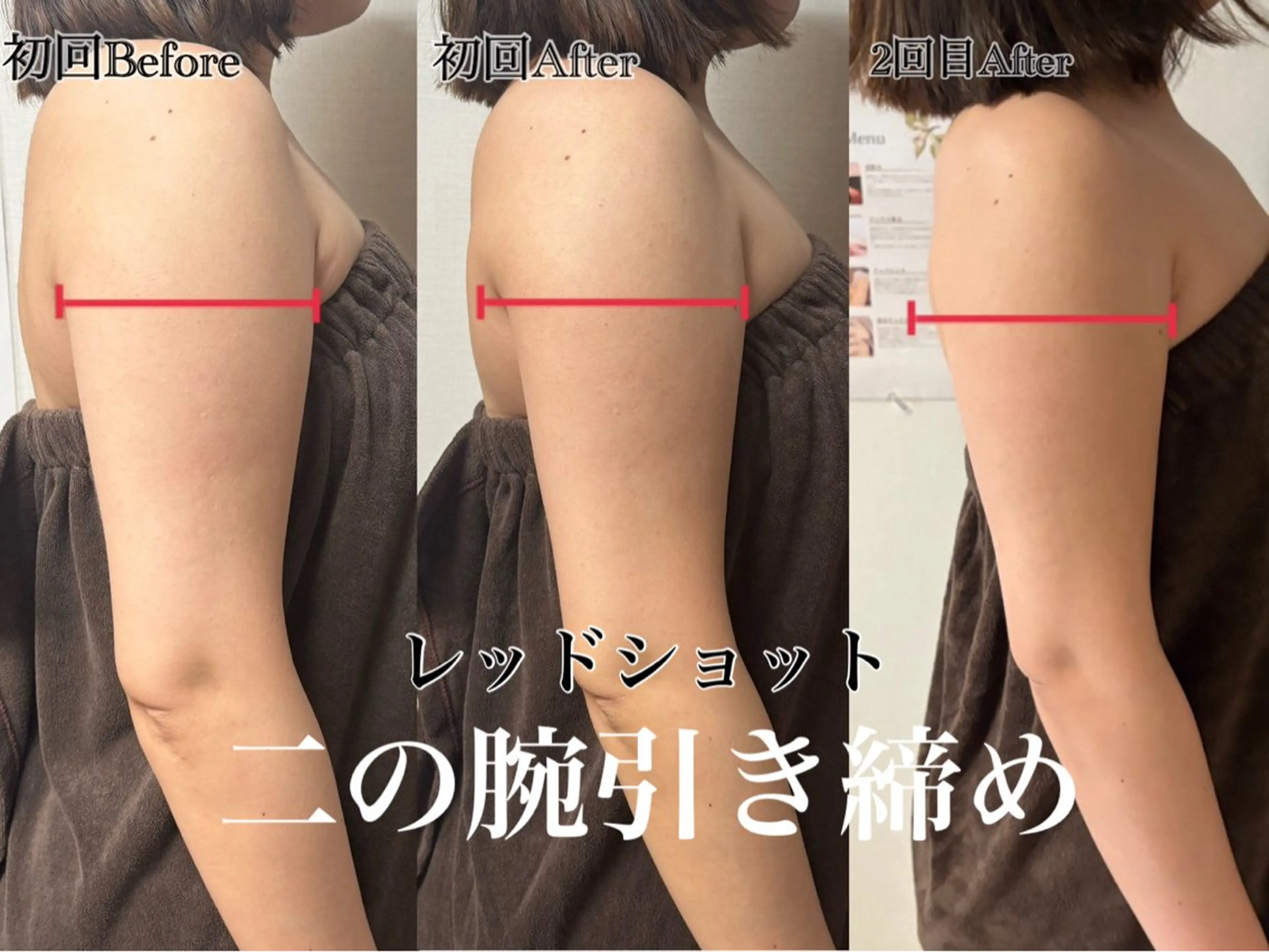 🔸【レッドショット導入価格】最新韓国発🇰🇷💉レッドショット3cc❤️✨二の腕またはお腹の写真