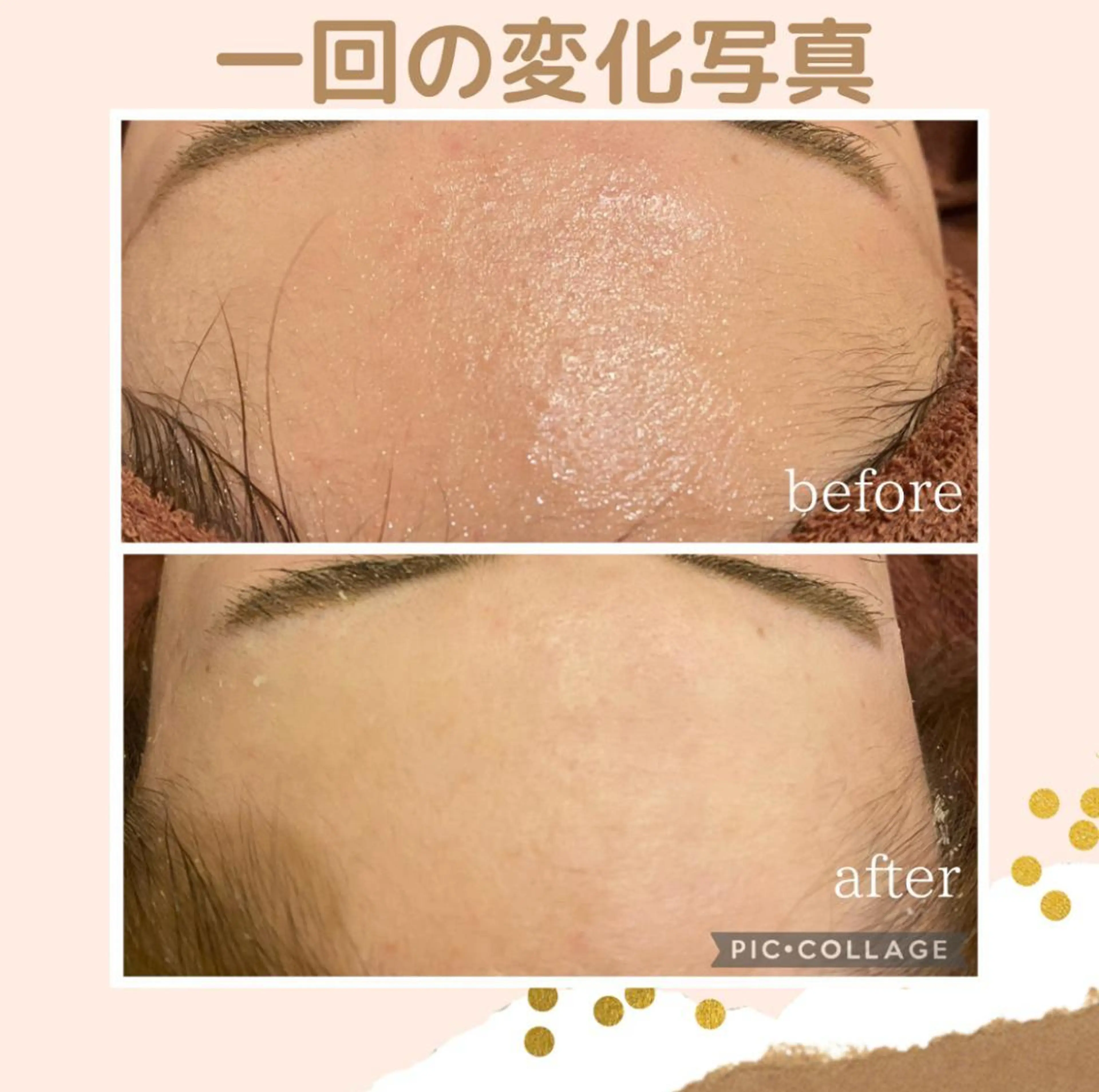 🔥3か月で肌革命 🔥ニキビ専門店のエステ・リラクイメージ