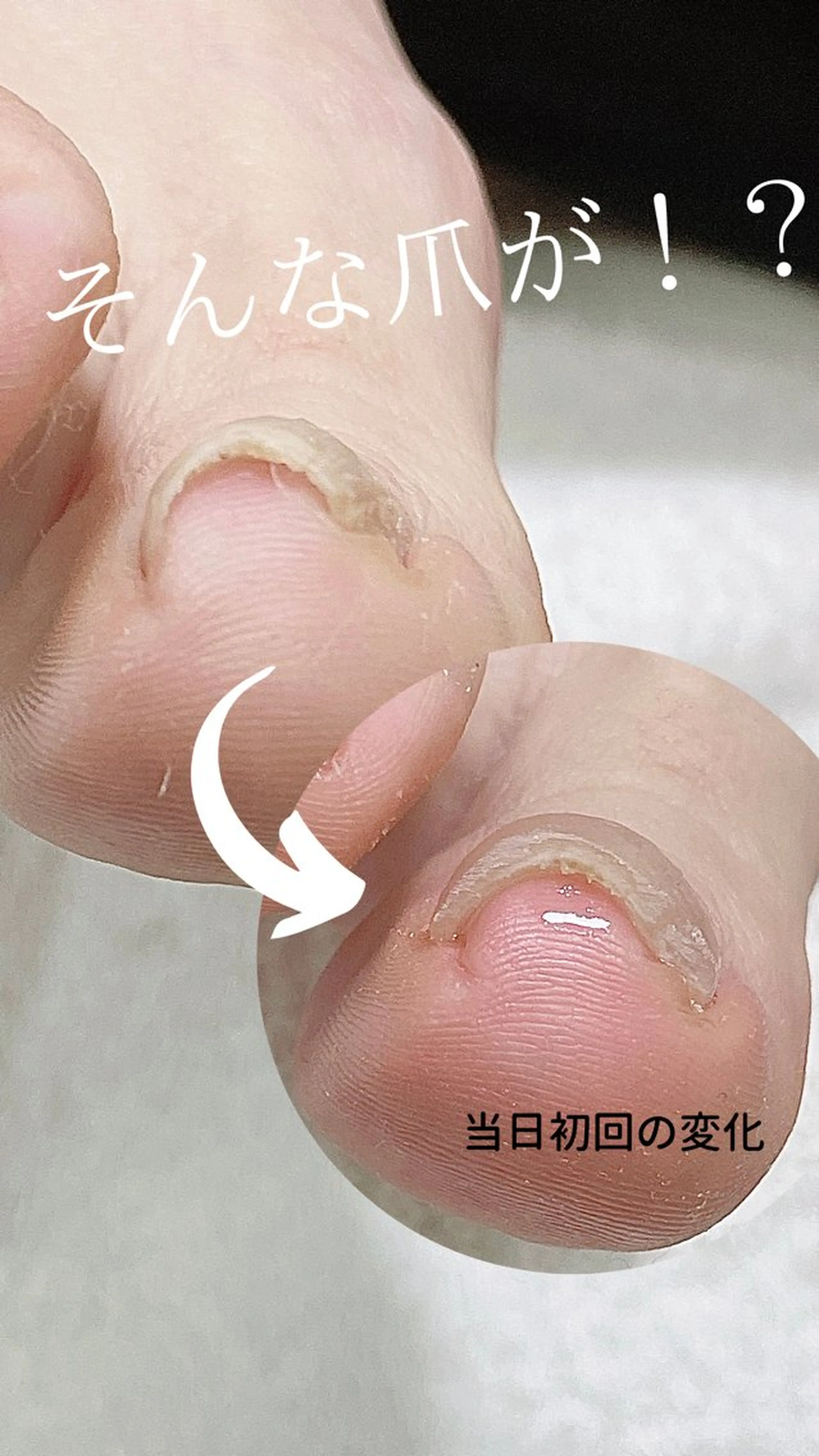 ネイル 深爪・巻き爪 専門サンセリテのネイルデザイン