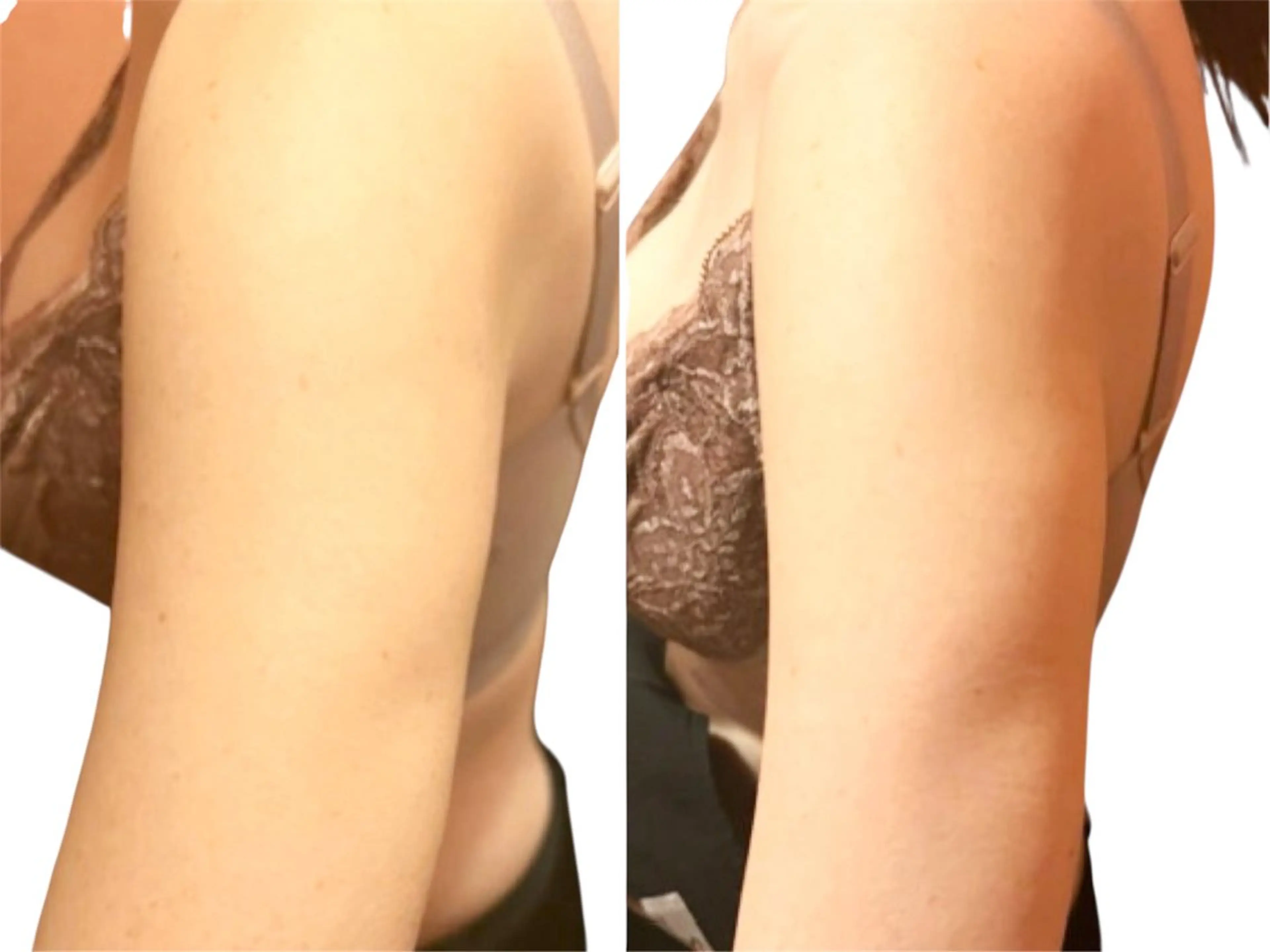 【限定5名さまモニター価格】プライムセラム高濃度排出！たぷたぷ二の腕解消の写真