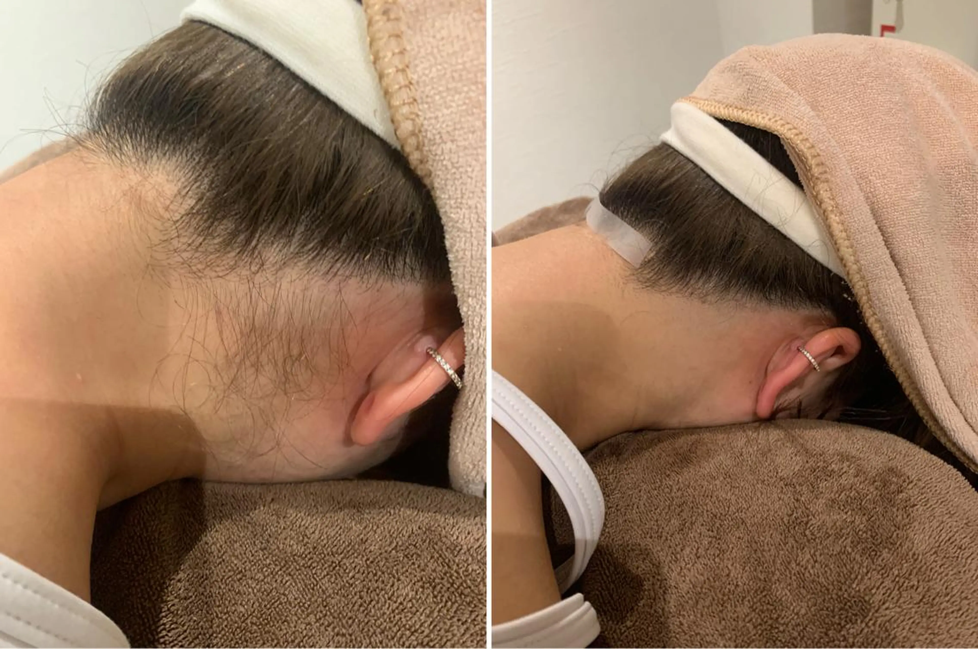 襟足脱毛の写真