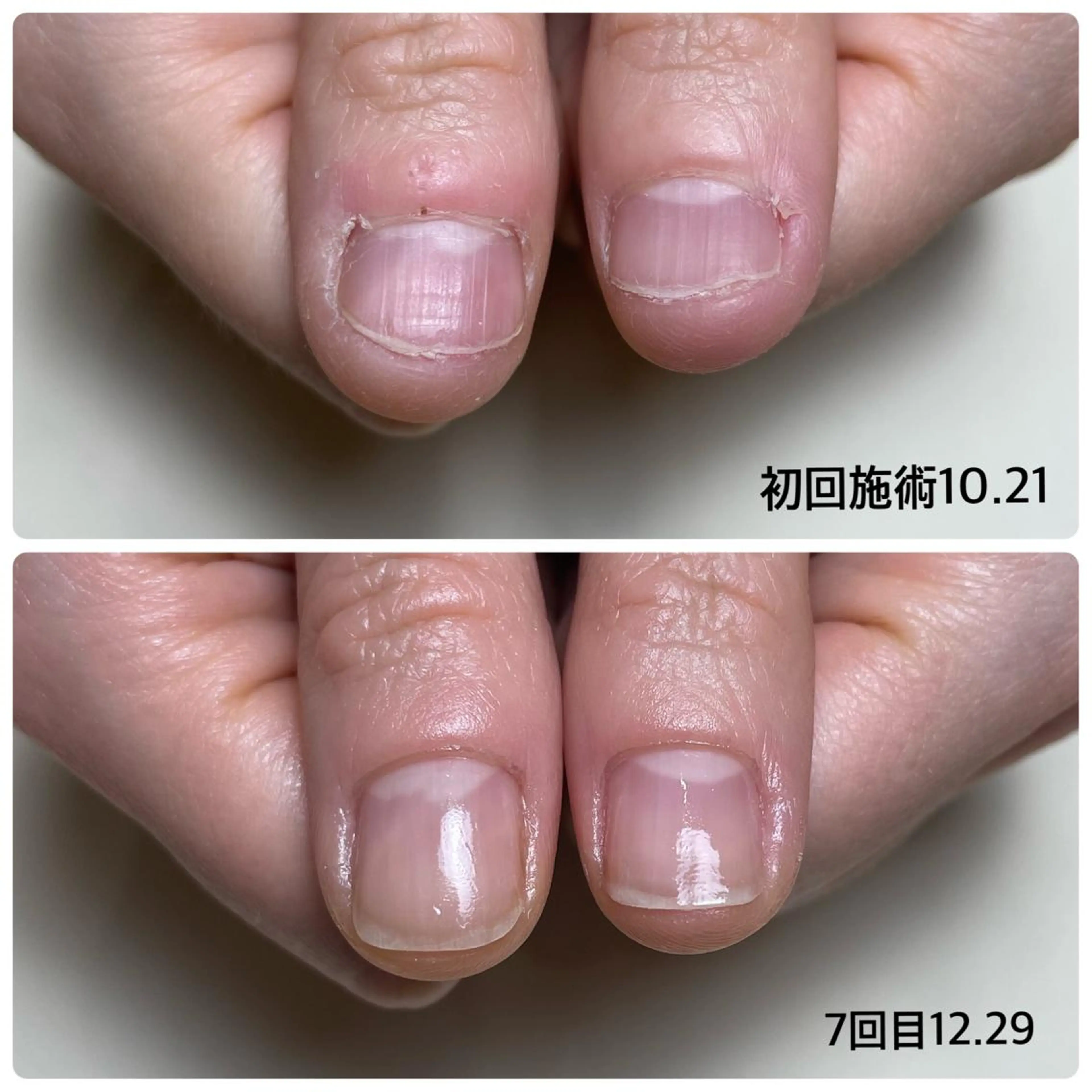 ネイル Nail ビ爪のネイルデザイン