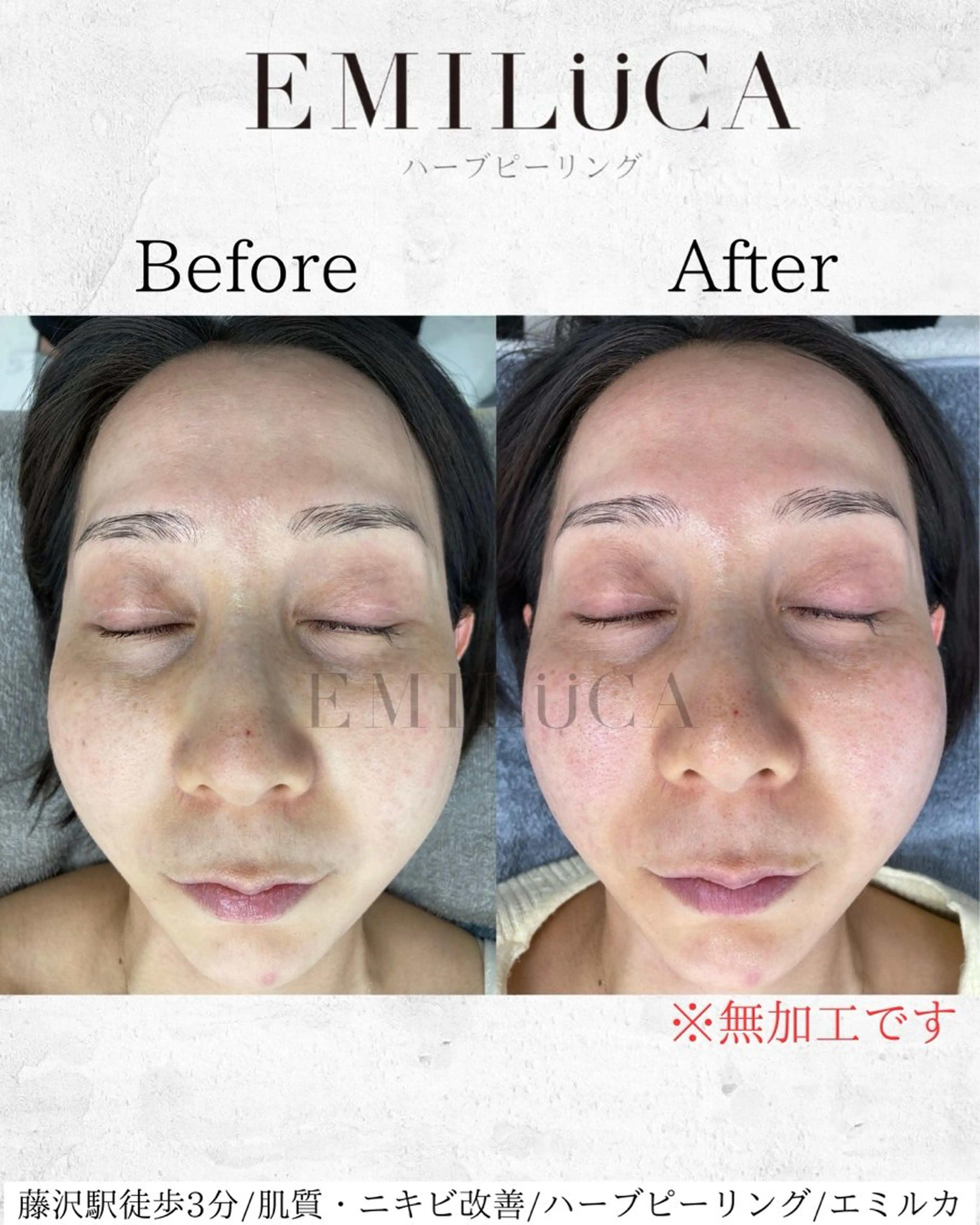 エステ ハーブピーリング専門EMILUCA藤沢所属・ハーブピーリング /KAEDEのエステ・リラクイメージ