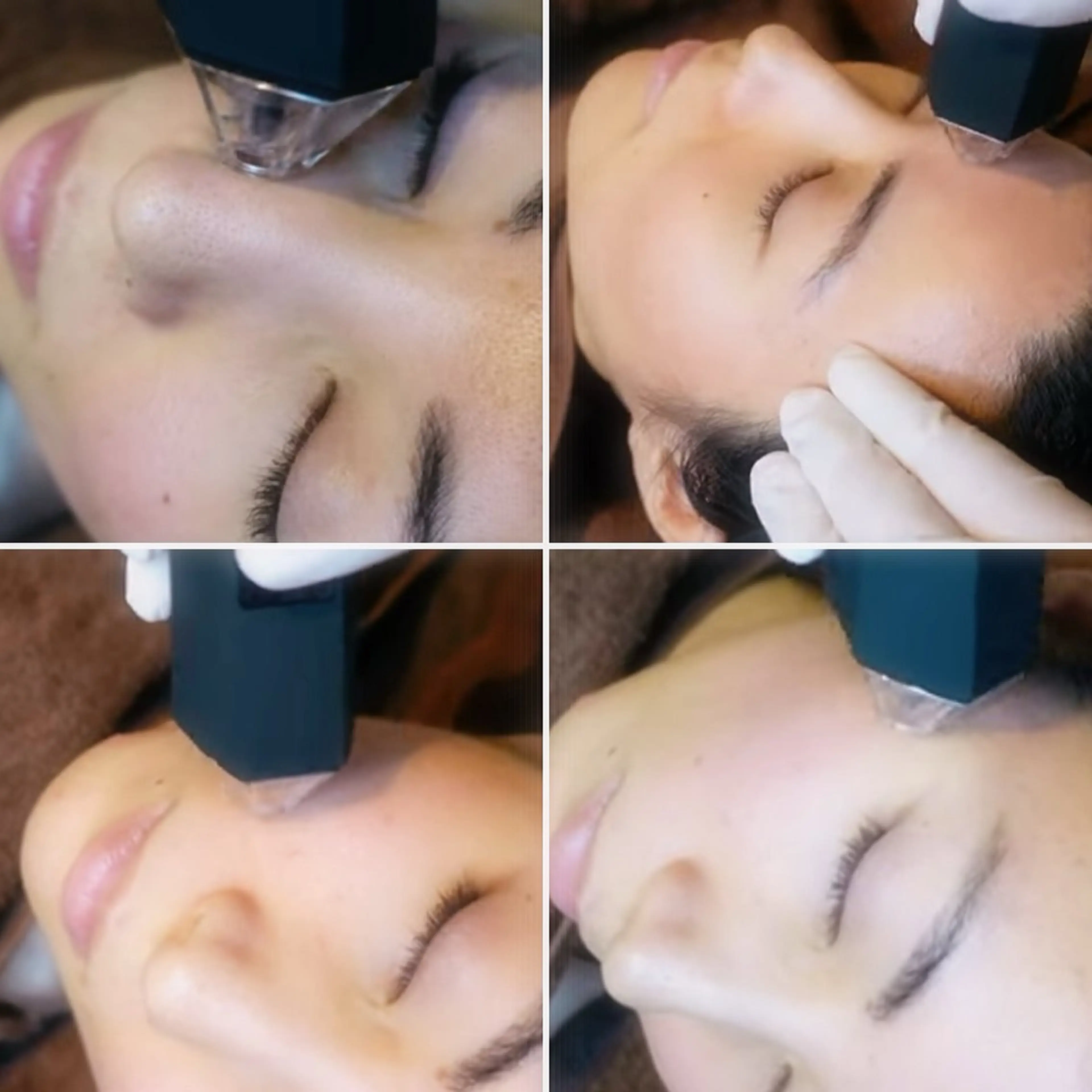 サイエンス美容プログラム✨14日間✨プラズマニードルの写真