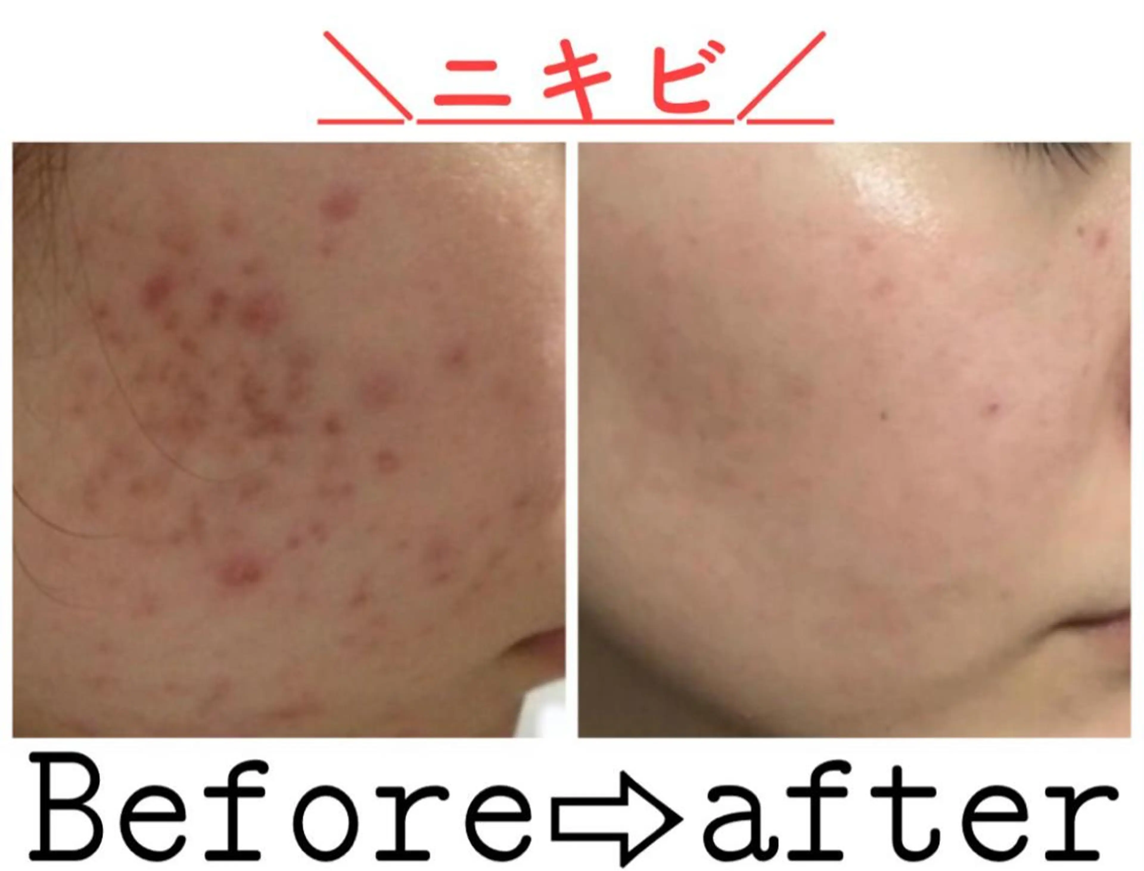 ミディアム カラー パーマ ヘアアレンジ メンズ キッズ ネイル マツエク・マツパ エステ ニキビ&跡改善サロン オーナー光木のエステ・リラクイメージ