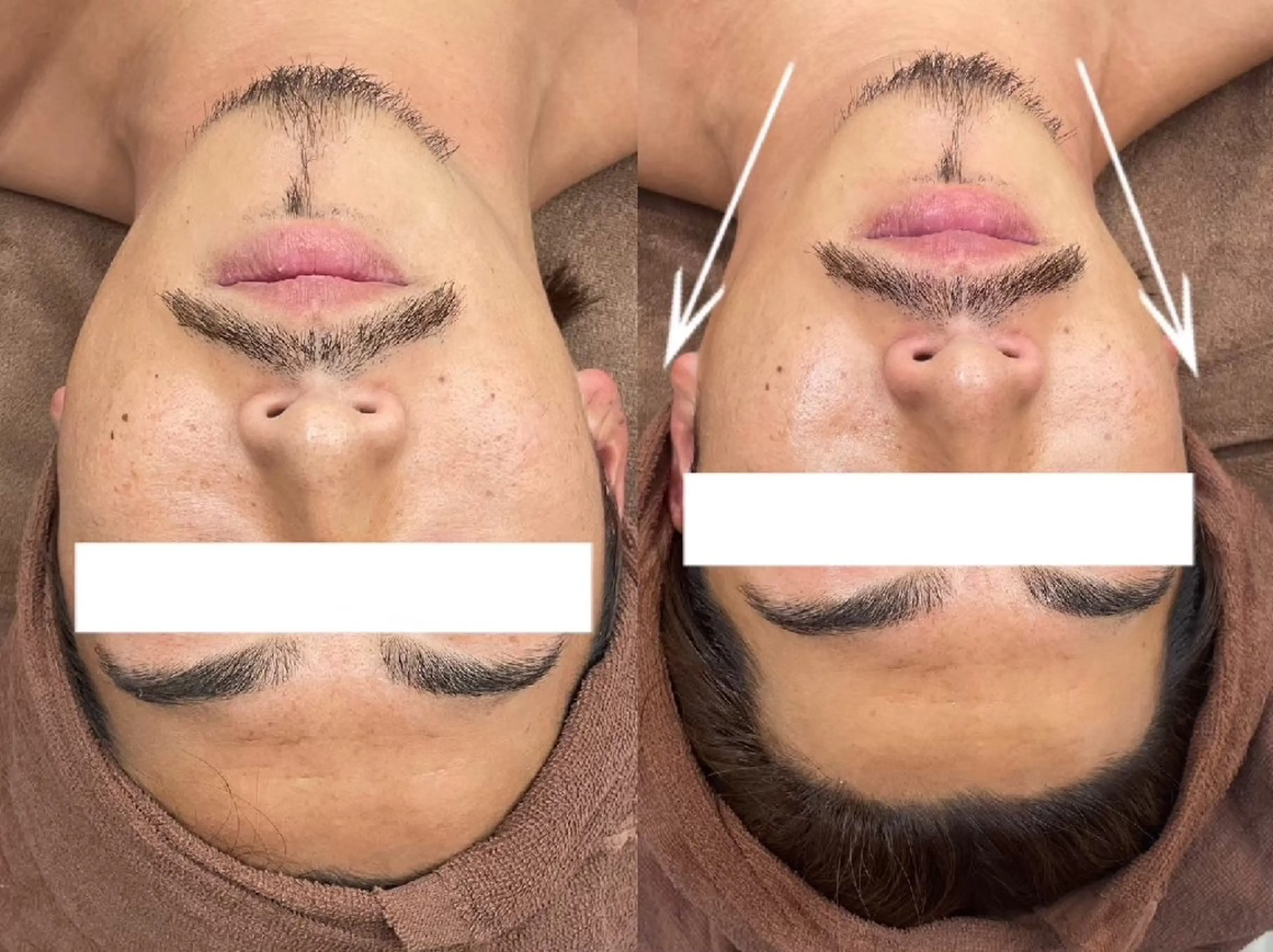 糸リフト発想の【小顔フェイシャル高出力ラジオ波×吸引＋高保湿パック】リフトアップ/フェイスライン/ぱっちり目/小顔✩の写真