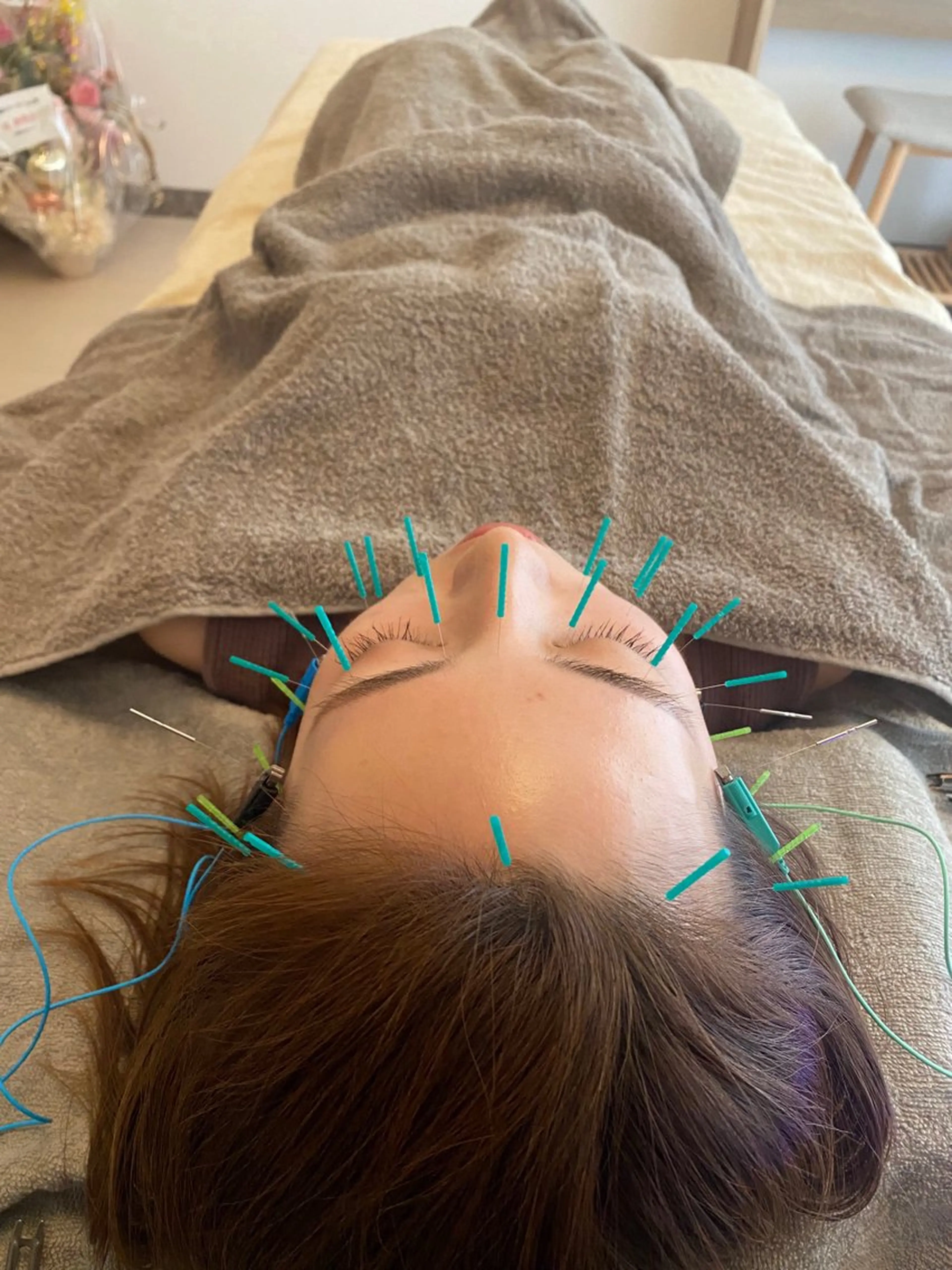 鍼灸•マッサージサロンCalfa所属・《美肌･小顔》美容鍼 ＆マッサージ＊MEIのエステ・リラクイメージ