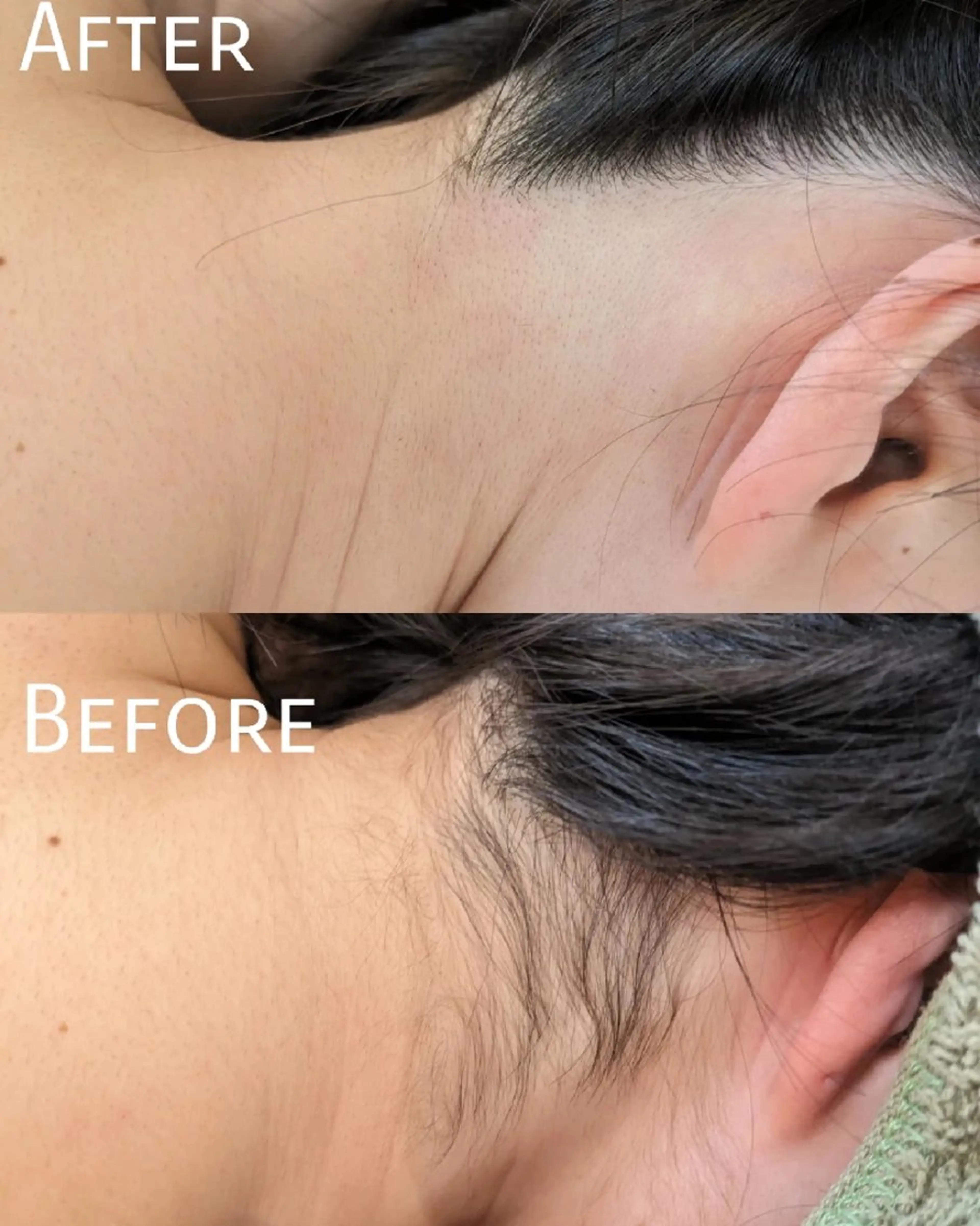 ✪初回お試し✪Sパーツ【うなじ、両脇など】口コミ投稿で1000円⭕️お試しといっても通常の技術とサービスをご提供‼️の写真