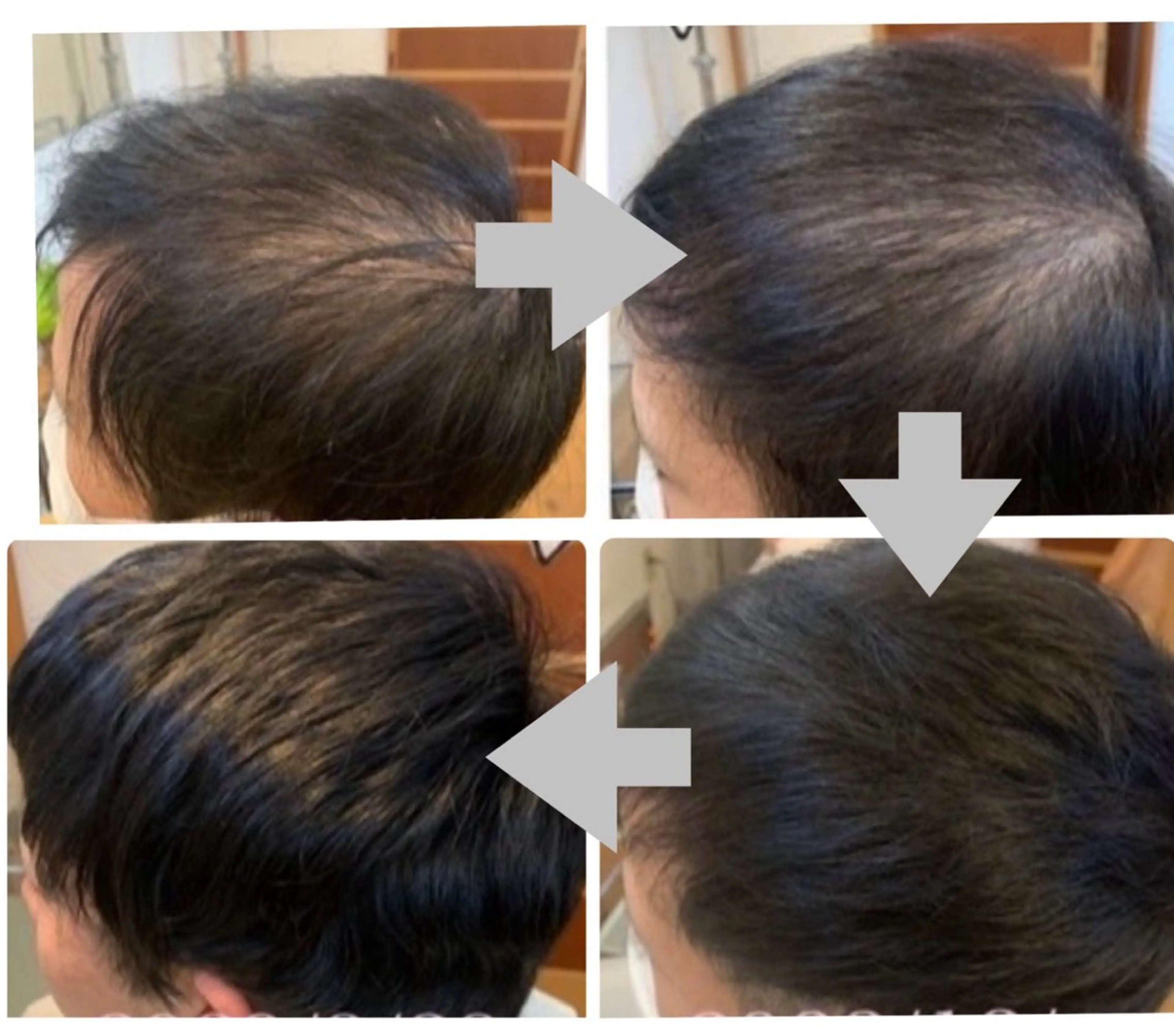 メンズ ヘッドスパ 抜毛 薄毛 白髪 頭皮改善 柳沢慶のヘアスタイル