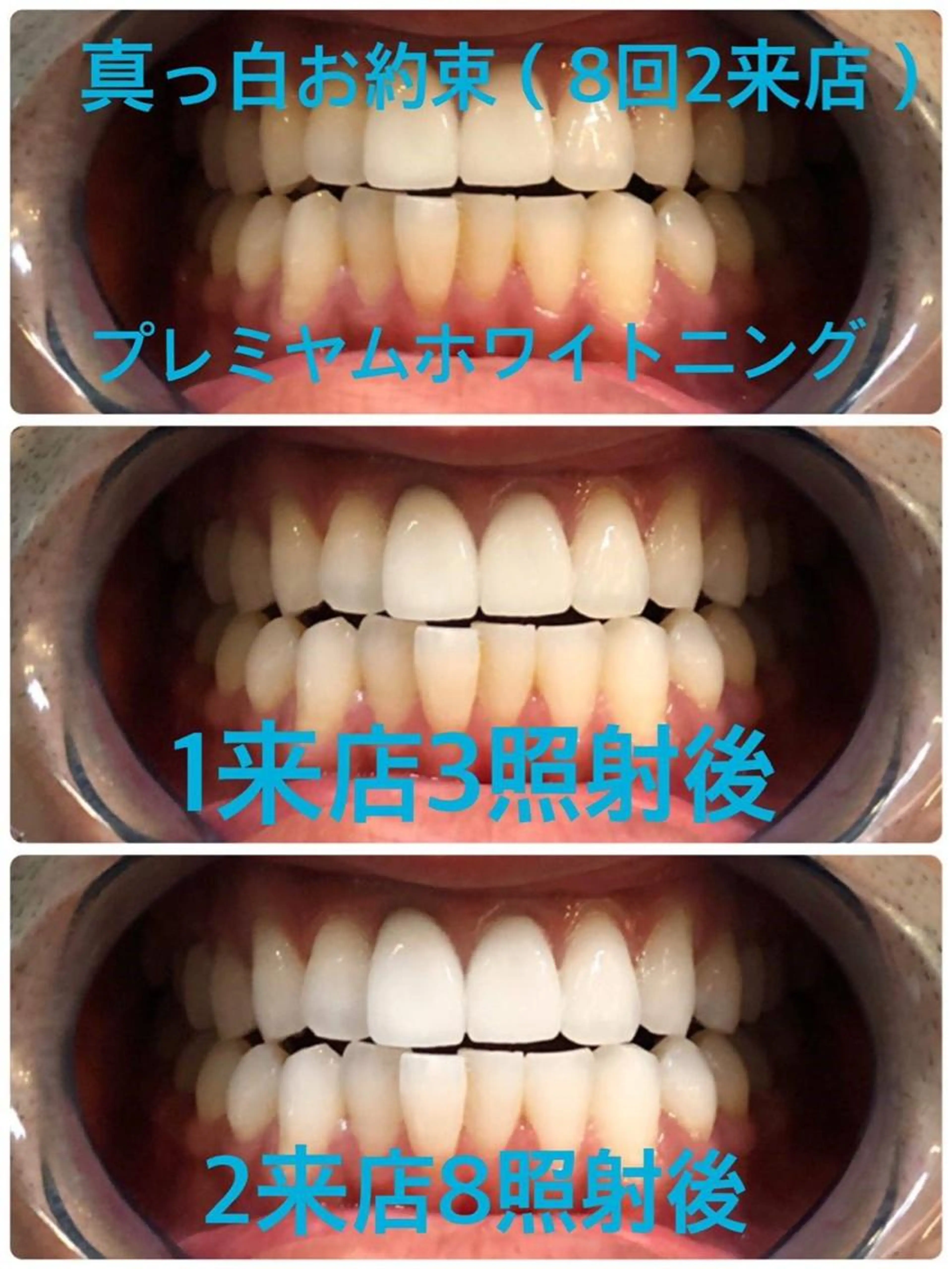 【初回限定】真っ白お約束🦷✨プレミアムホワイトニング❣️〈合計70分照射2来店コース〉❣️✨の写真