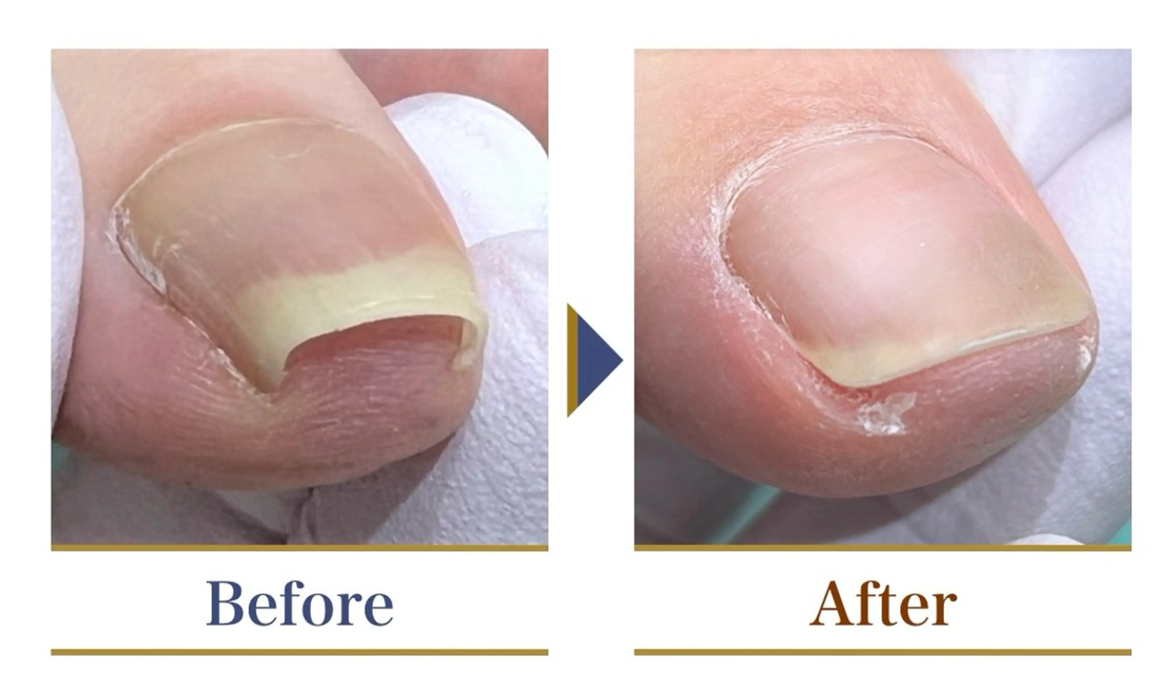 巻き爪補正店 横浜関内店のネイルデザイン