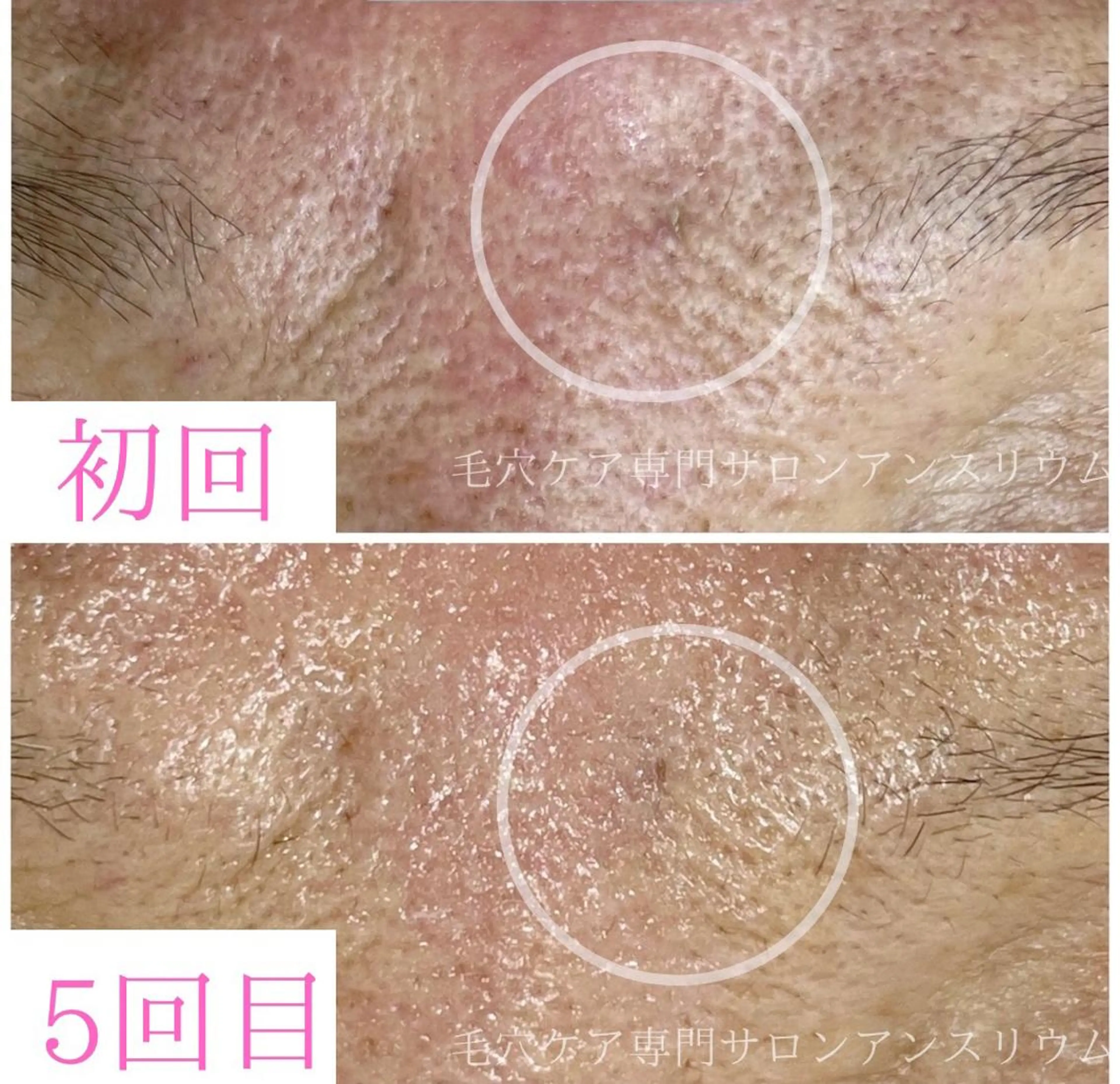 毛穴ケア専門サロンアンスリウム所属・茨城土浦 つくば毛穴 ケア専門サロンのエステ・リラクイメージ