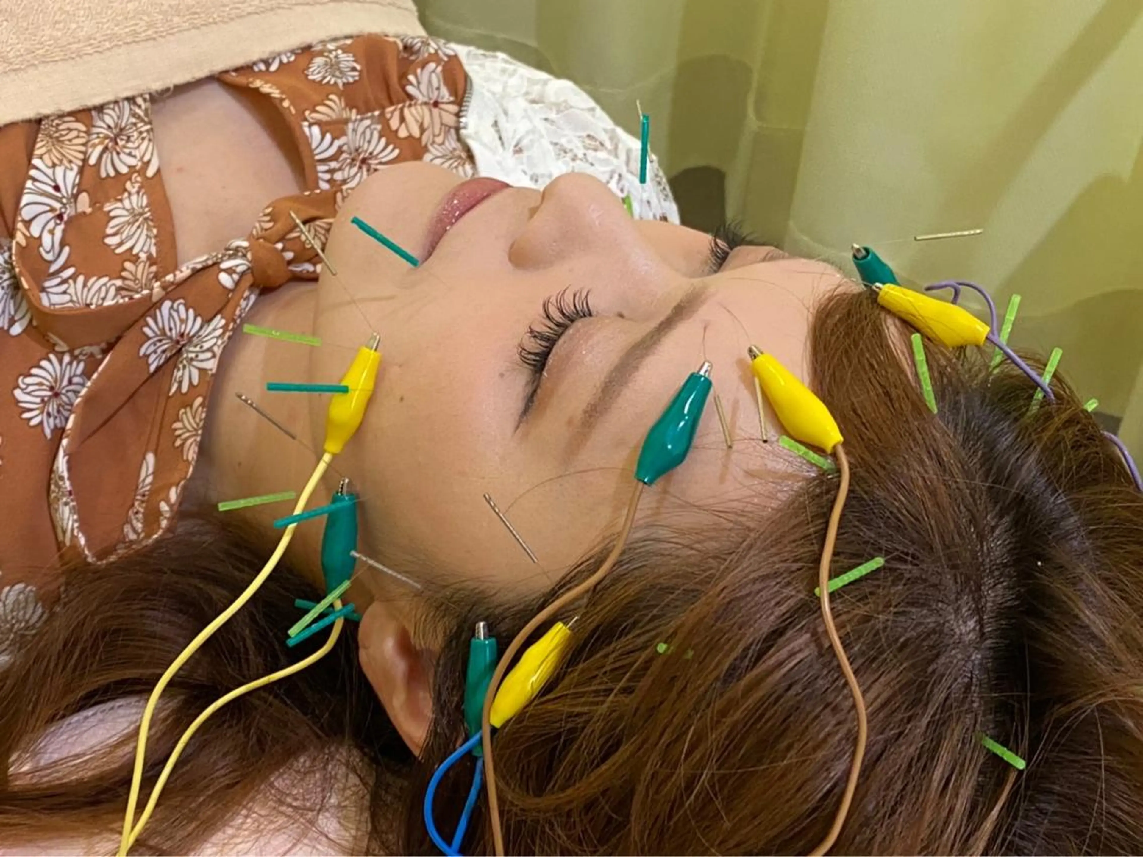 美容鍼プレミアム【電気✖︎頭皮鍼でリフトUP⤴️】の写真