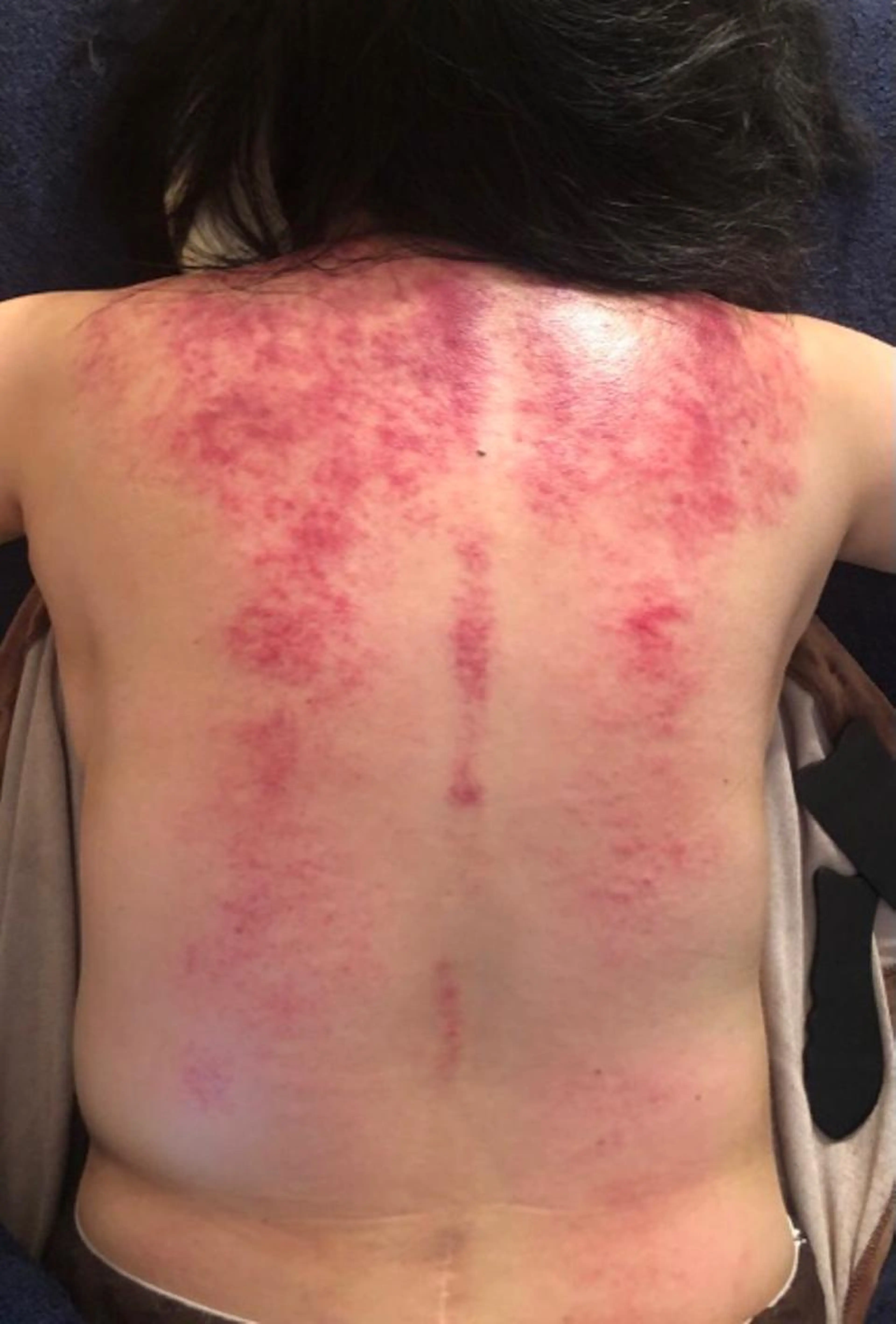 背中かっさ（肩から腰）漢方アロマオイルを使ってかっさしますの写真